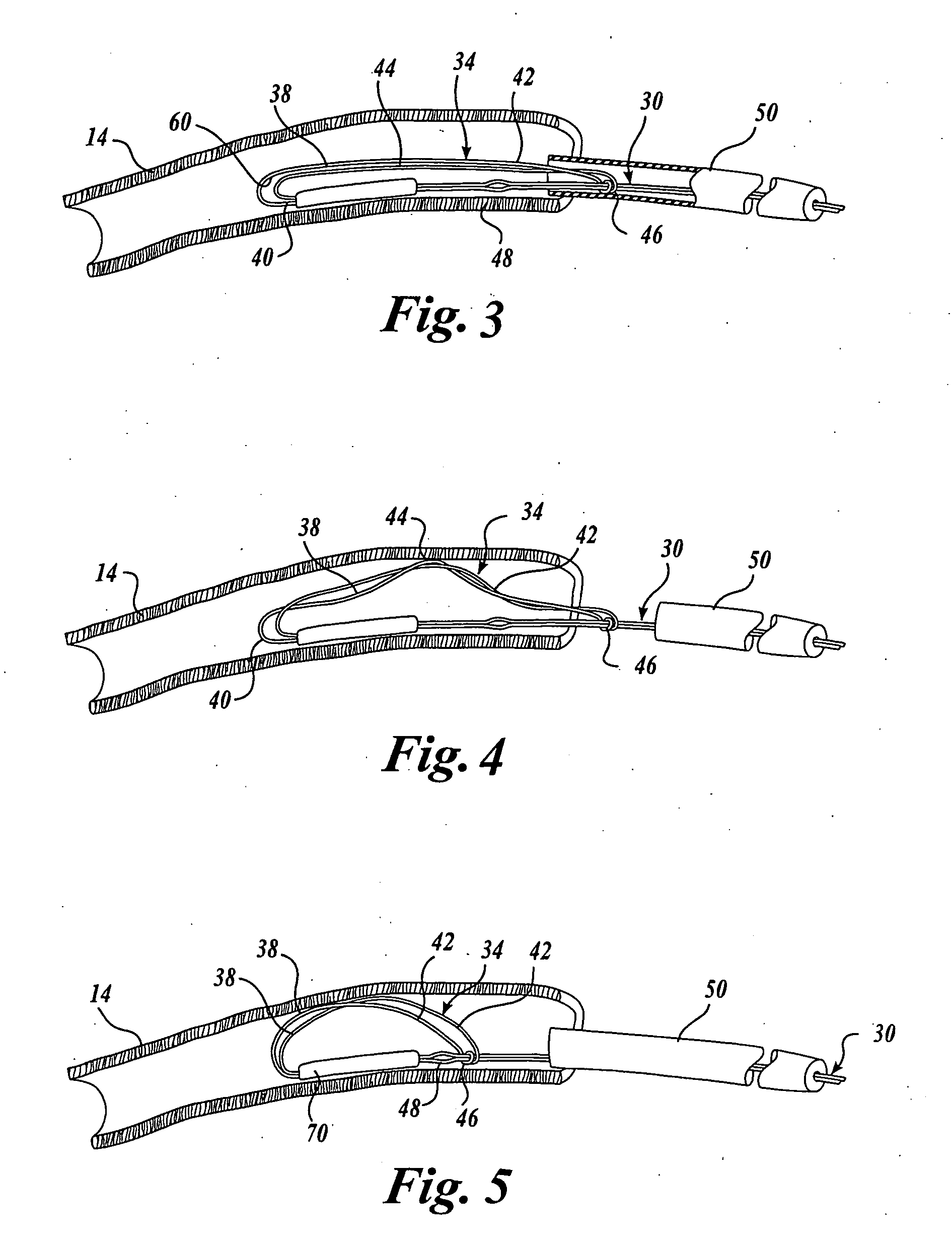 Body lumen device anchor, device and assembly