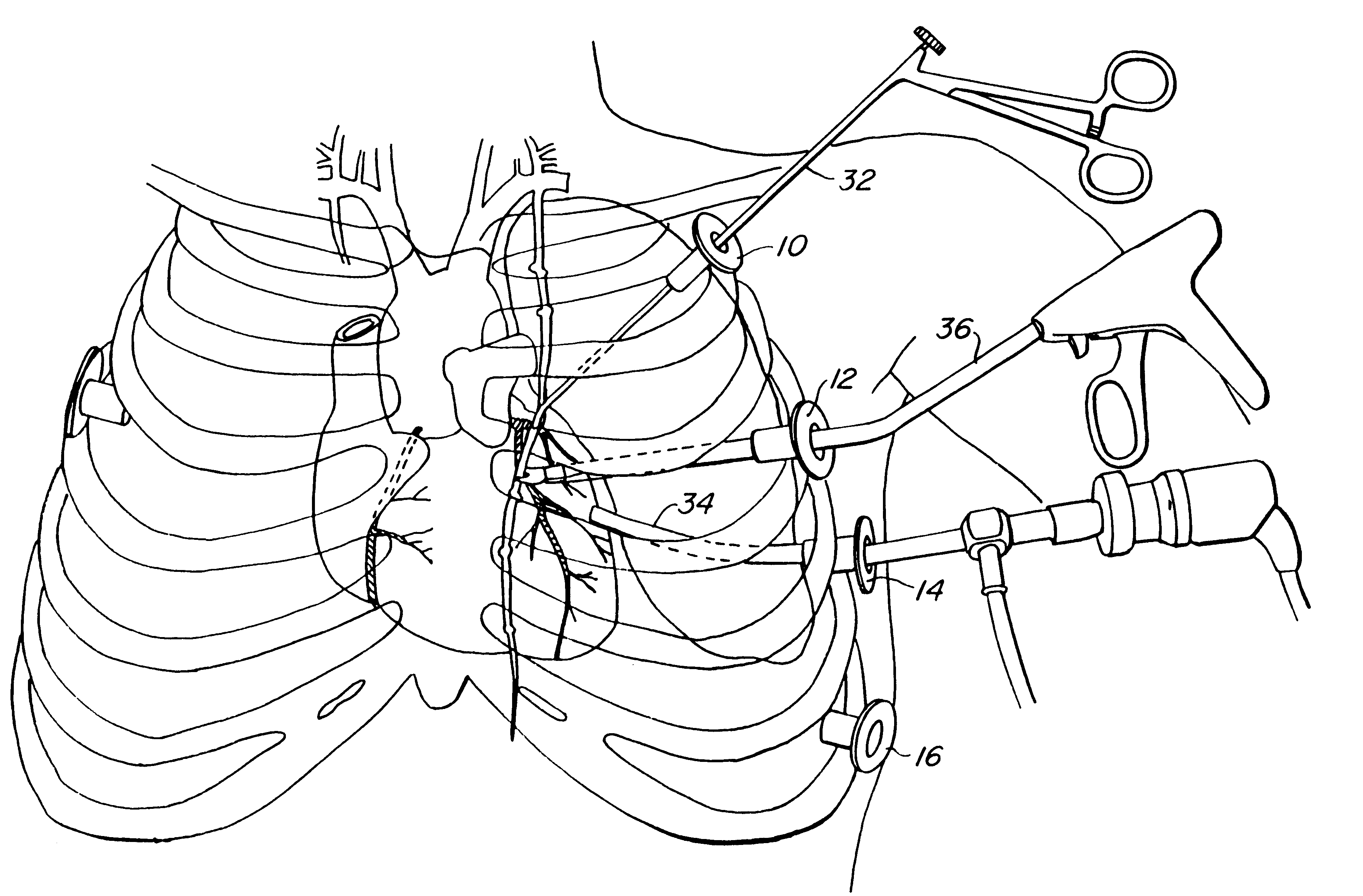 Method and systems for performing thoracoscopic cardiac bypass and other procedures