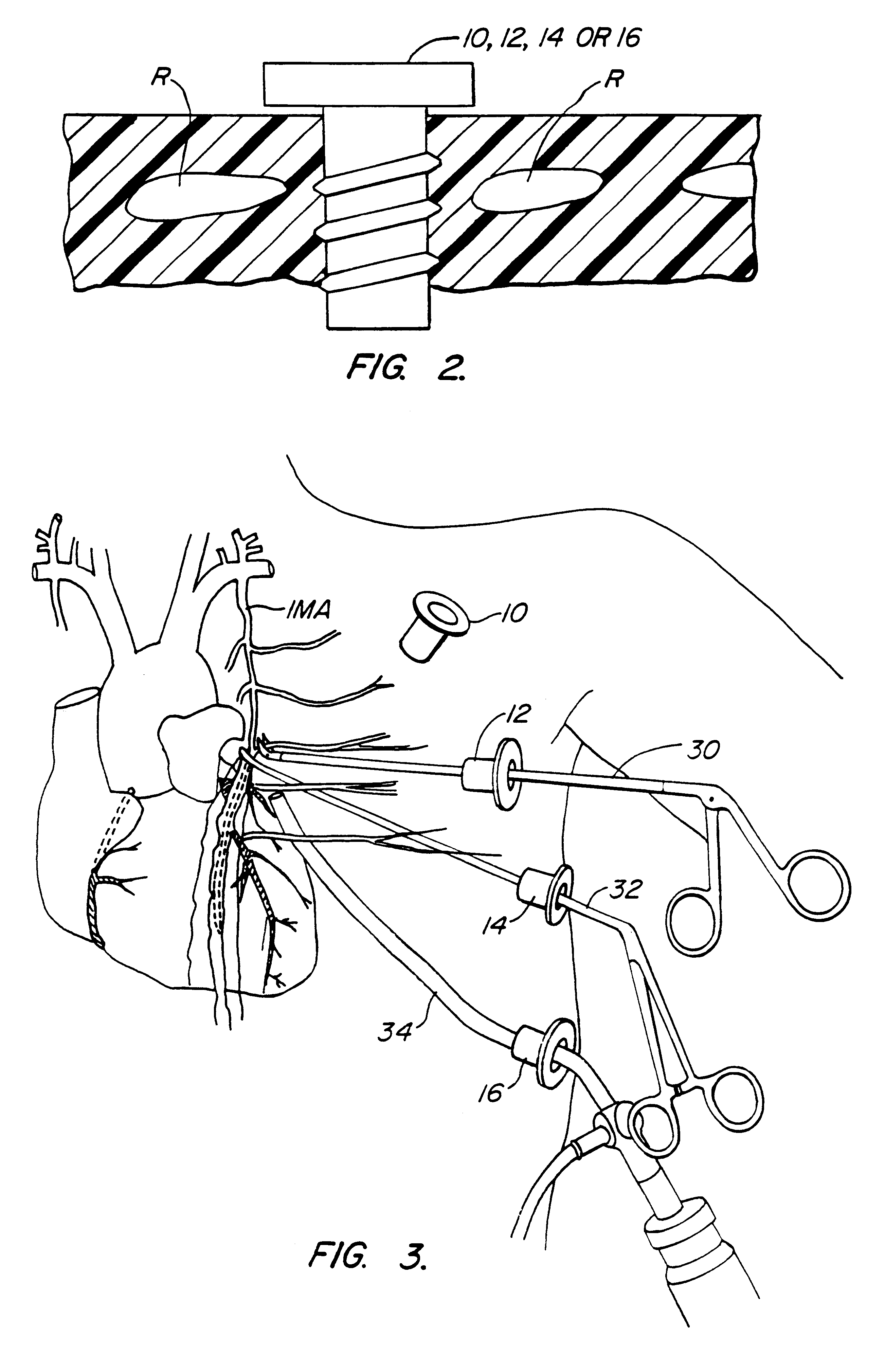 Method and systems for performing thoracoscopic cardiac bypass and other procedures