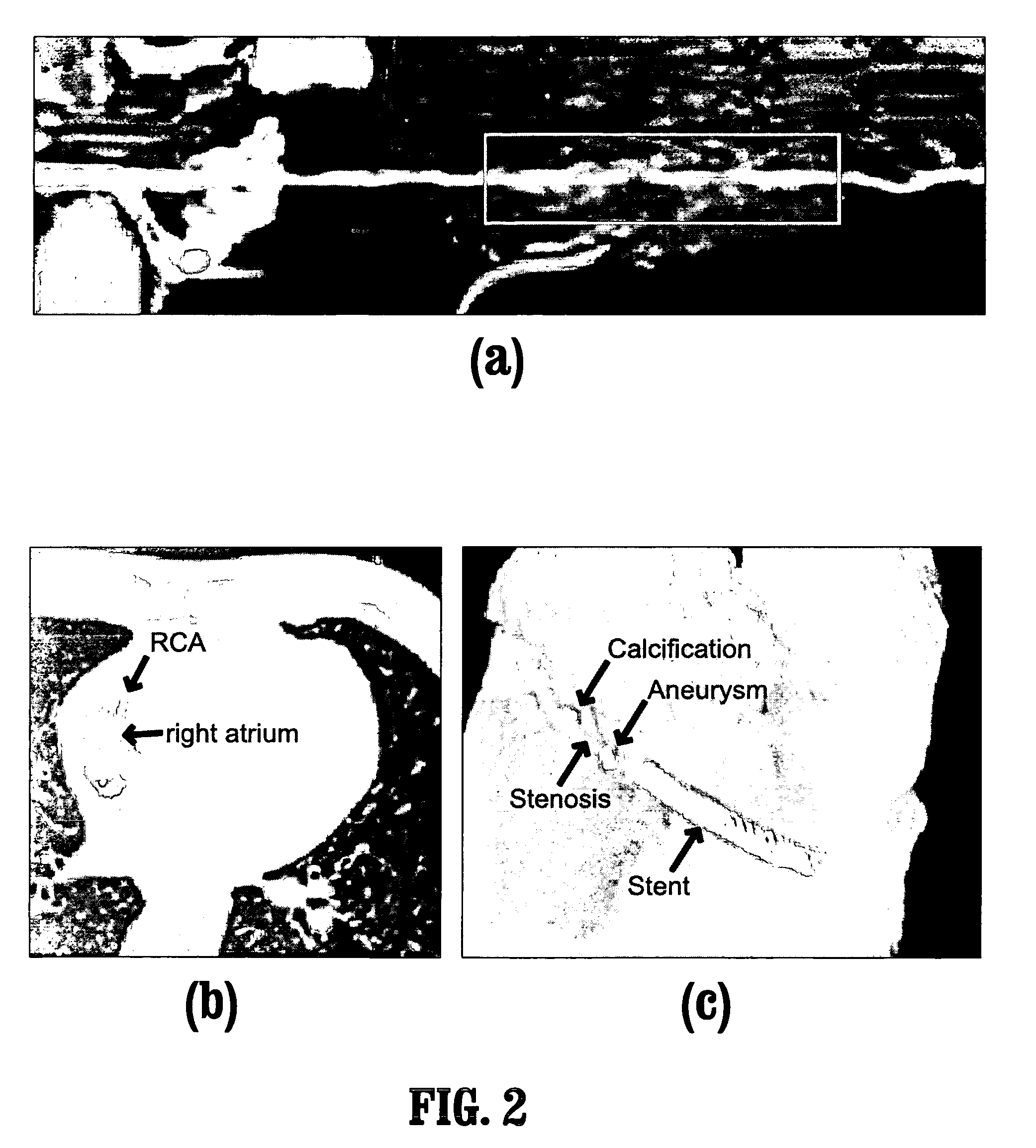 System and method for coronary artery segmentation of cardiac CT volumes