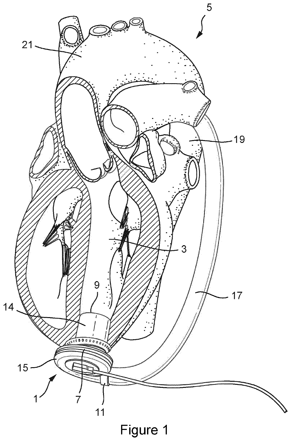 A cardiac pump