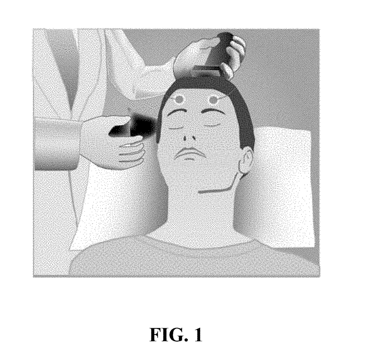 Skull implanted electrode assembly for brain stimulation