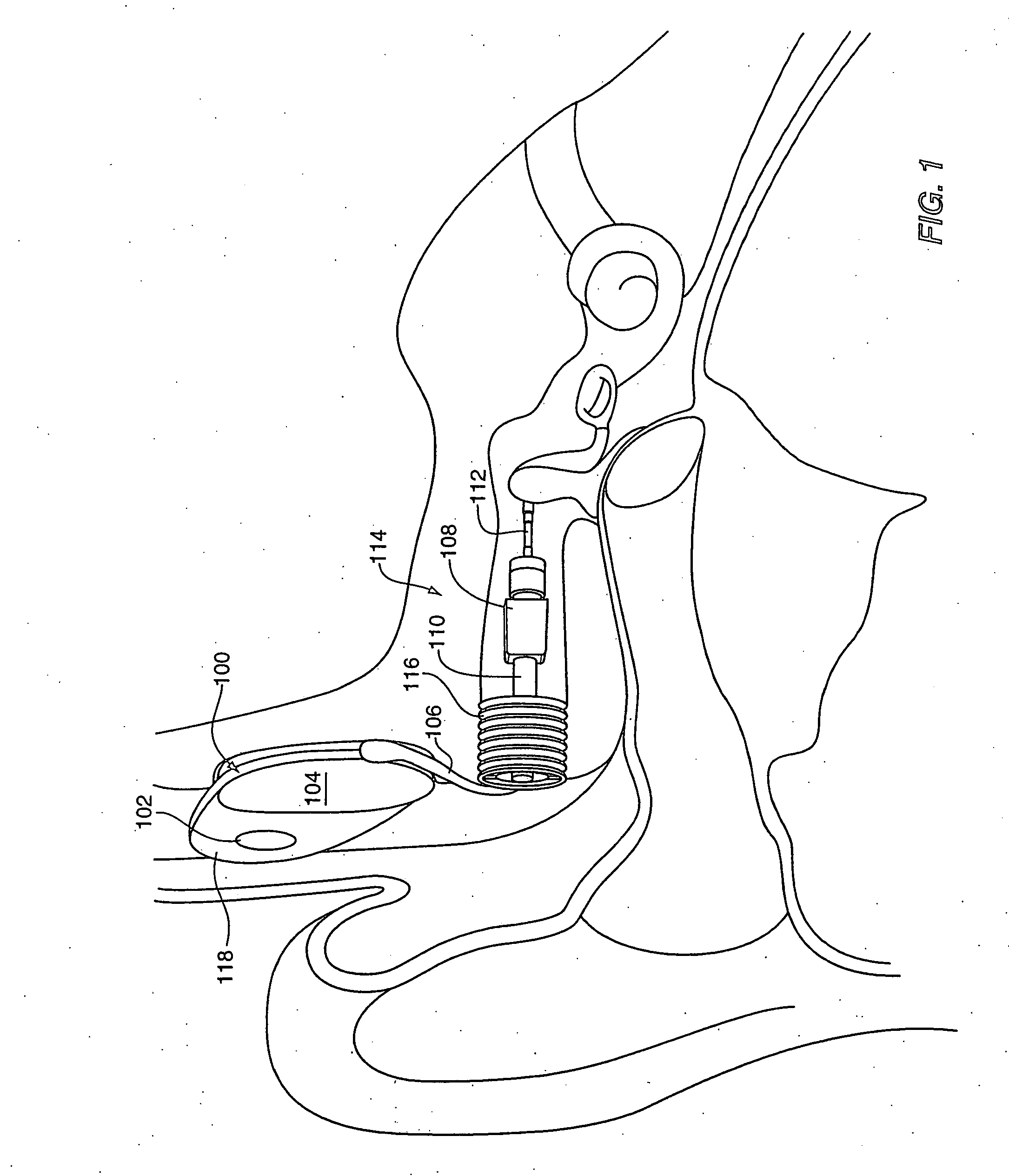 Method and system for external assessment of hearing aids that include implanted actuators