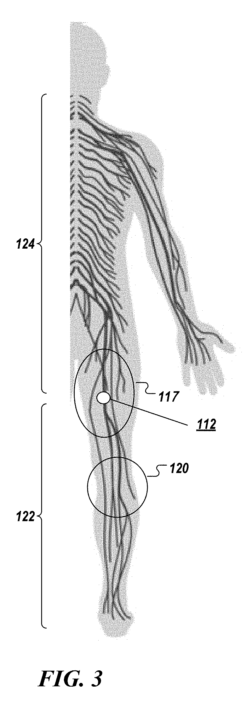 Treatment kit to percutaneously block painful sensations hosted by a peripheral nerve