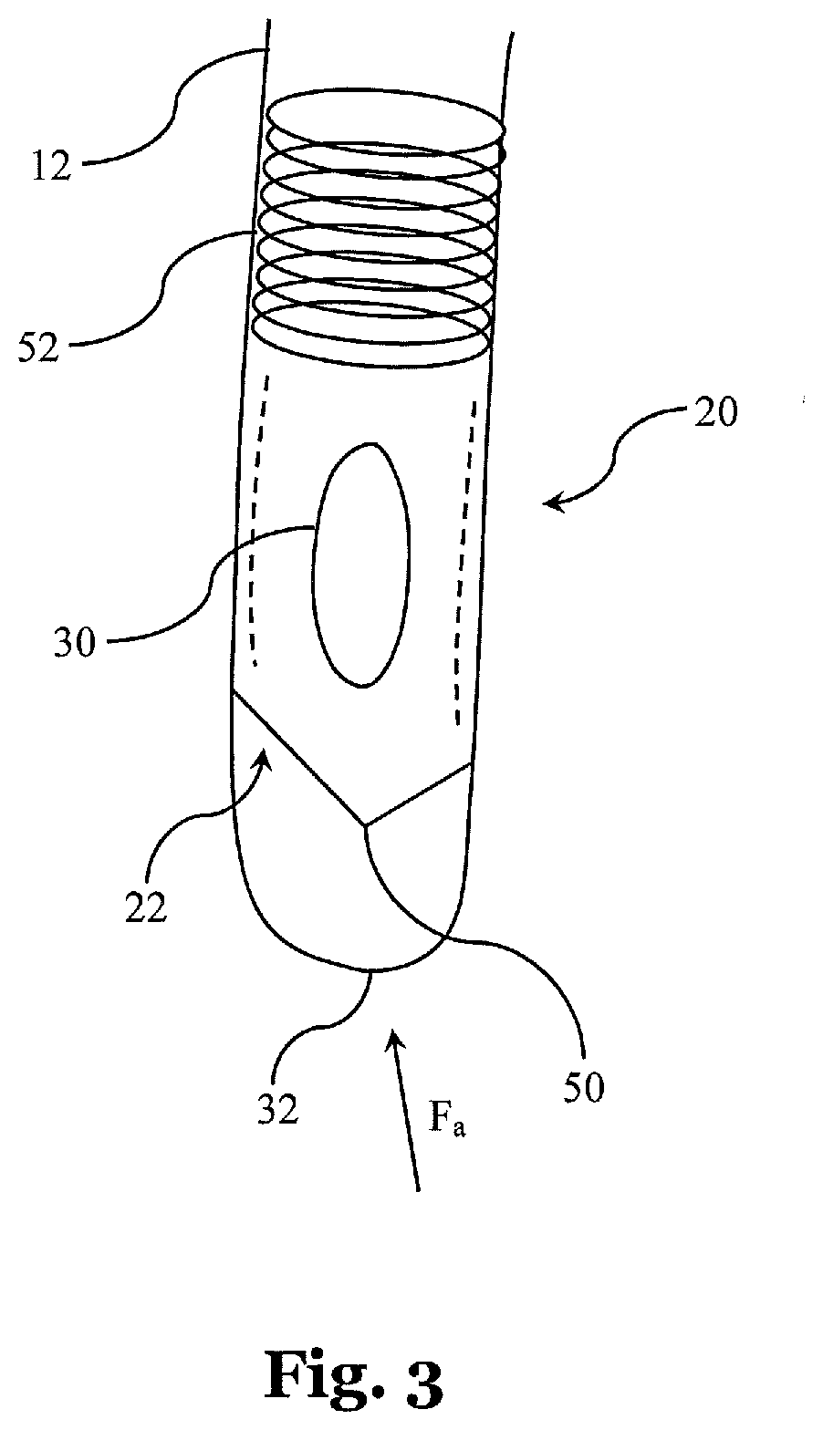 Needle assembly for relieving a pneumothorax