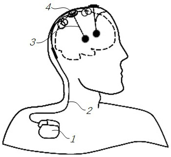 Implanted electrode and implanted electrical stimulation system