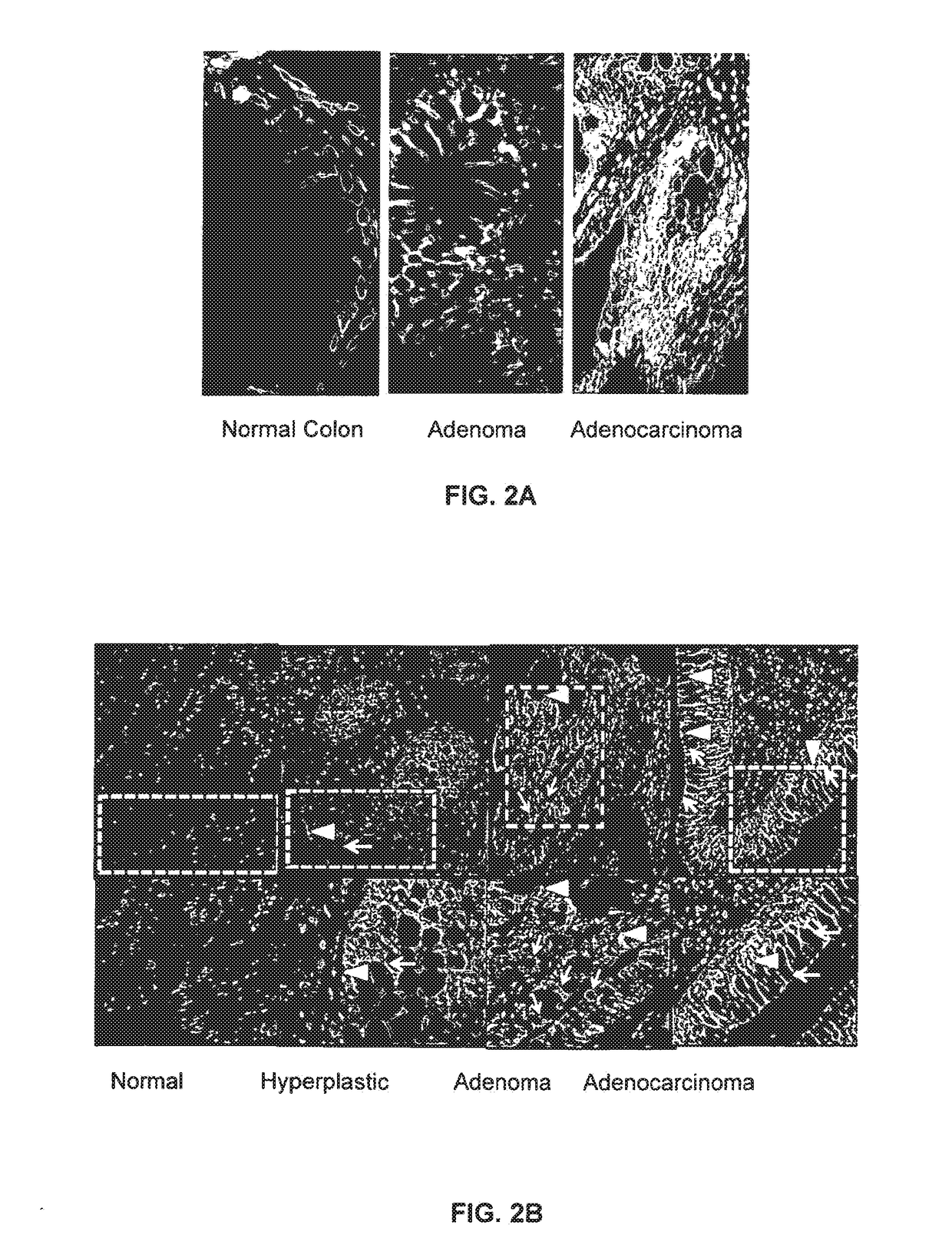 Diagnosis of benign and cancerous growths by measuring circulating tumor cells and serum annexina 2