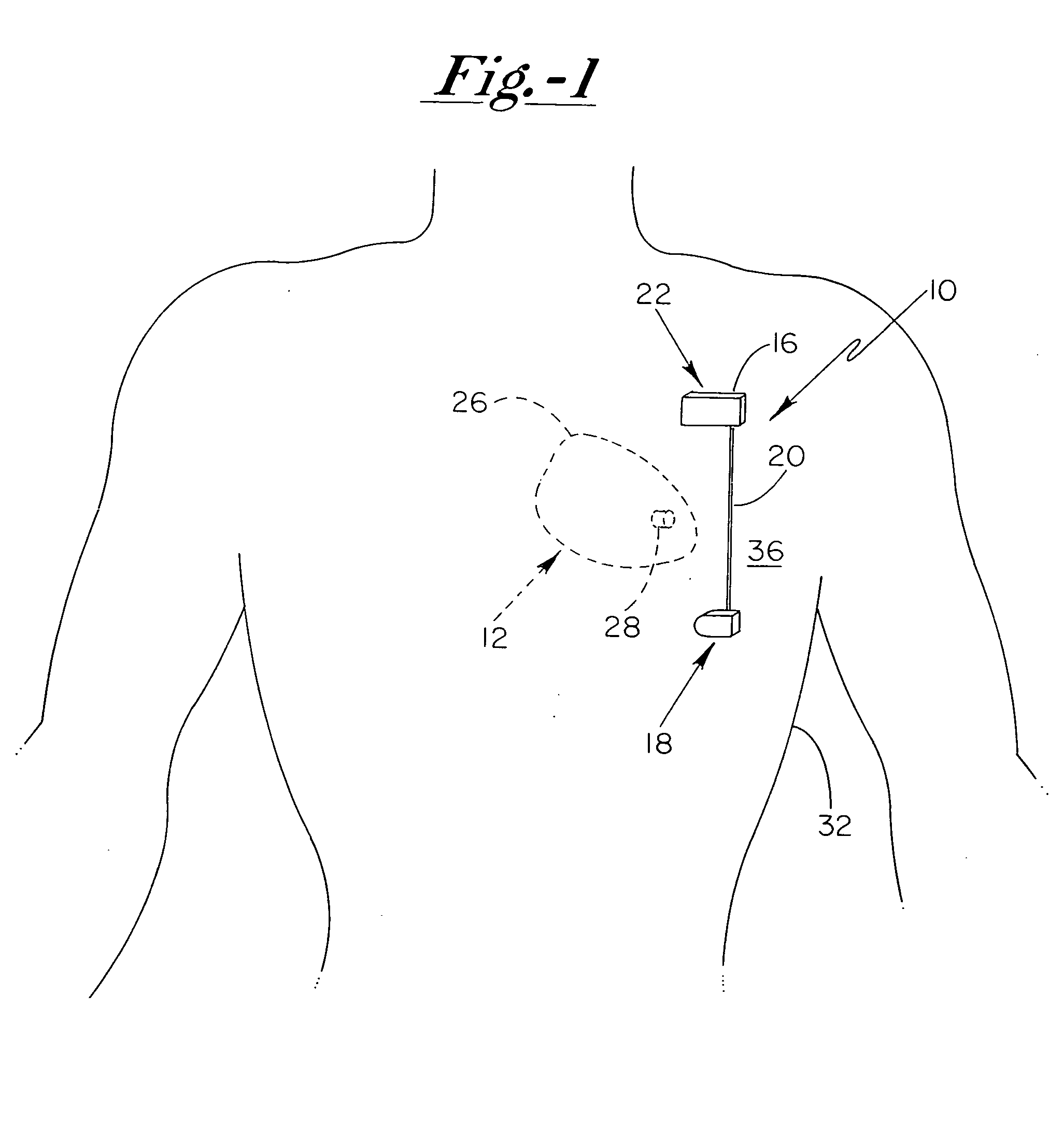 Anti-coagulation and demineralization system for conductive medical devices