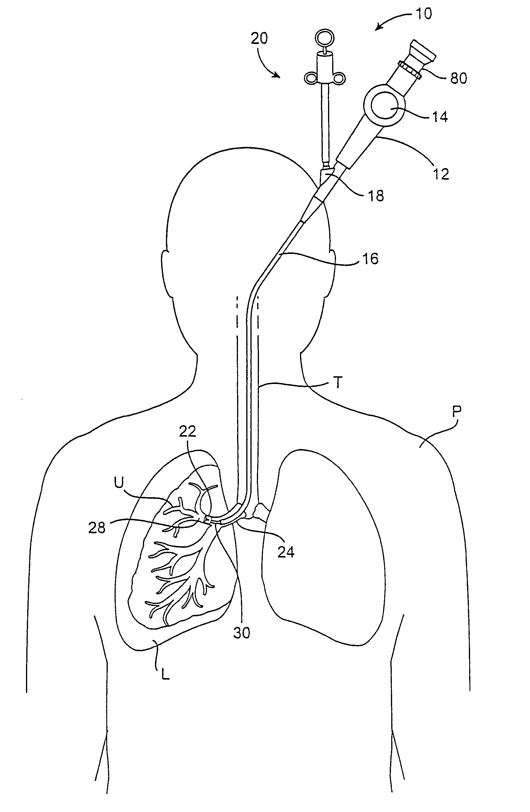 Methods and devices for use in performing pulmonary procedures