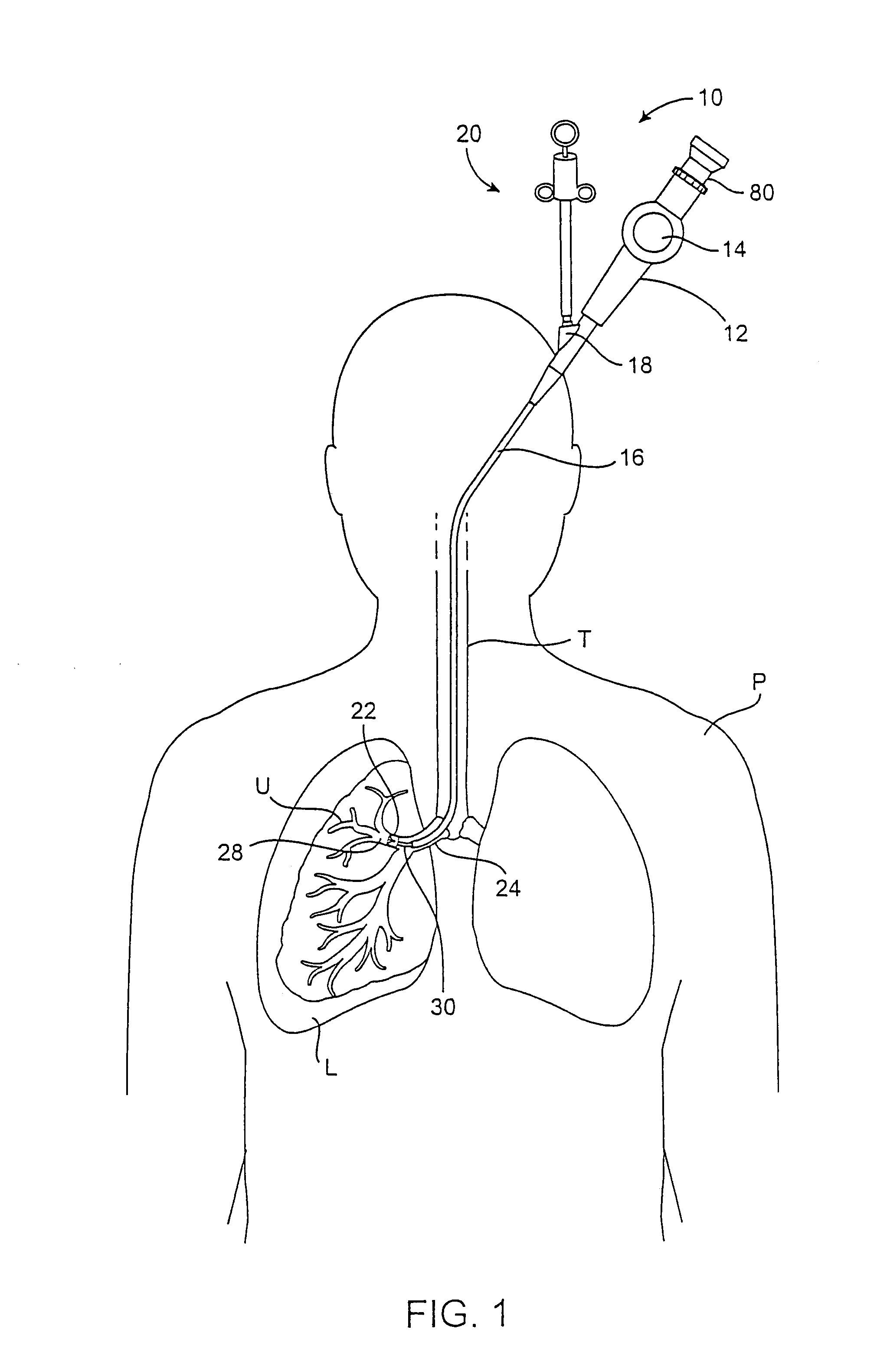 Methods and devices for use in performing pulmonary procedures