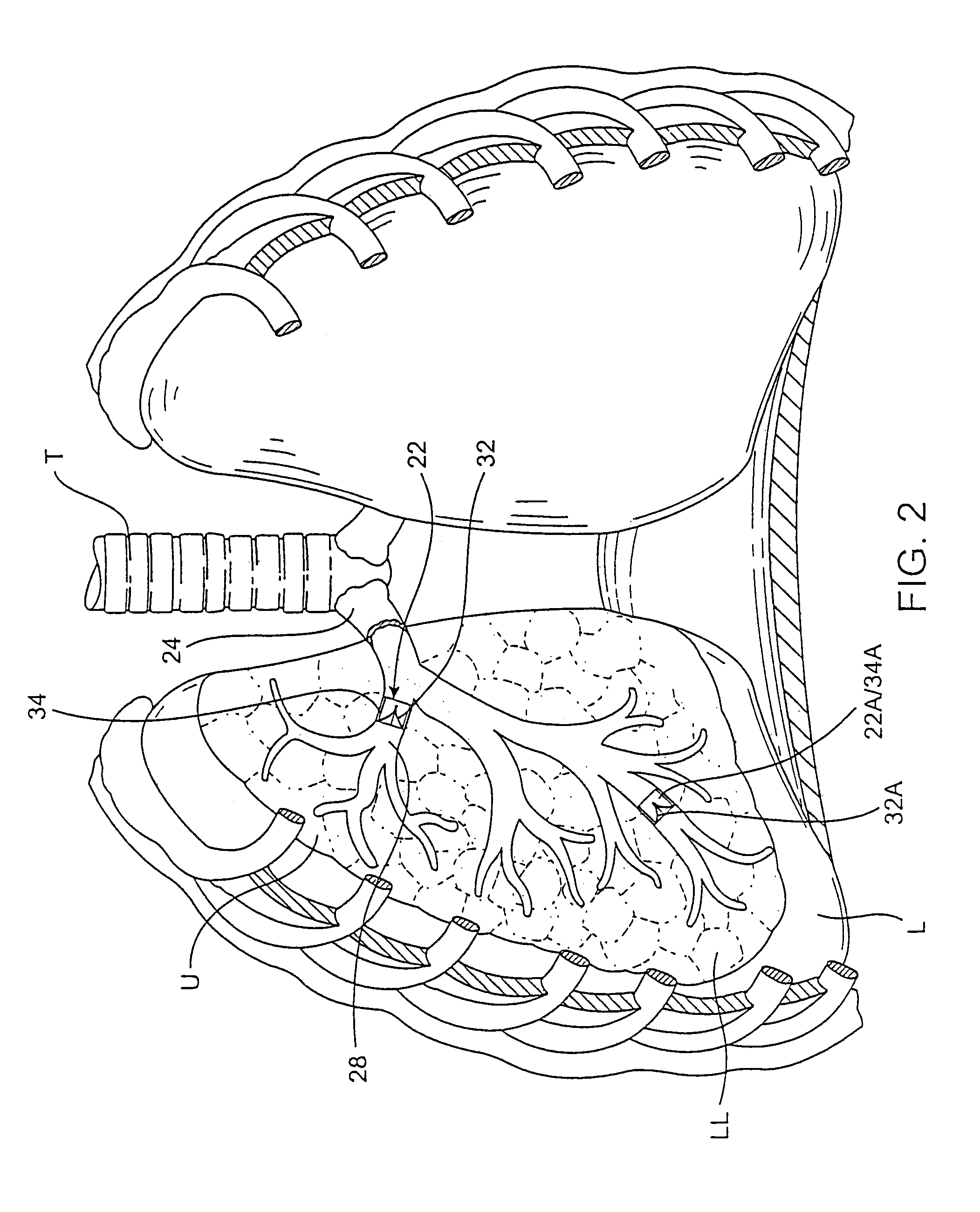 Methods and devices for use in performing pulmonary procedures