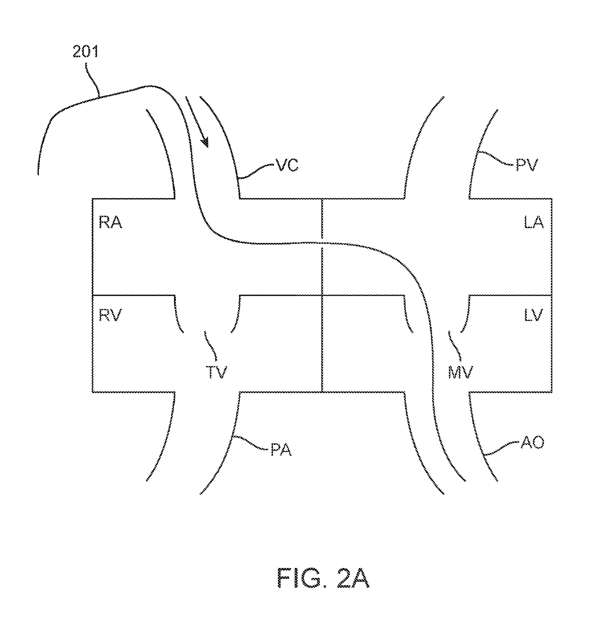 Antegrade hemodynamic support