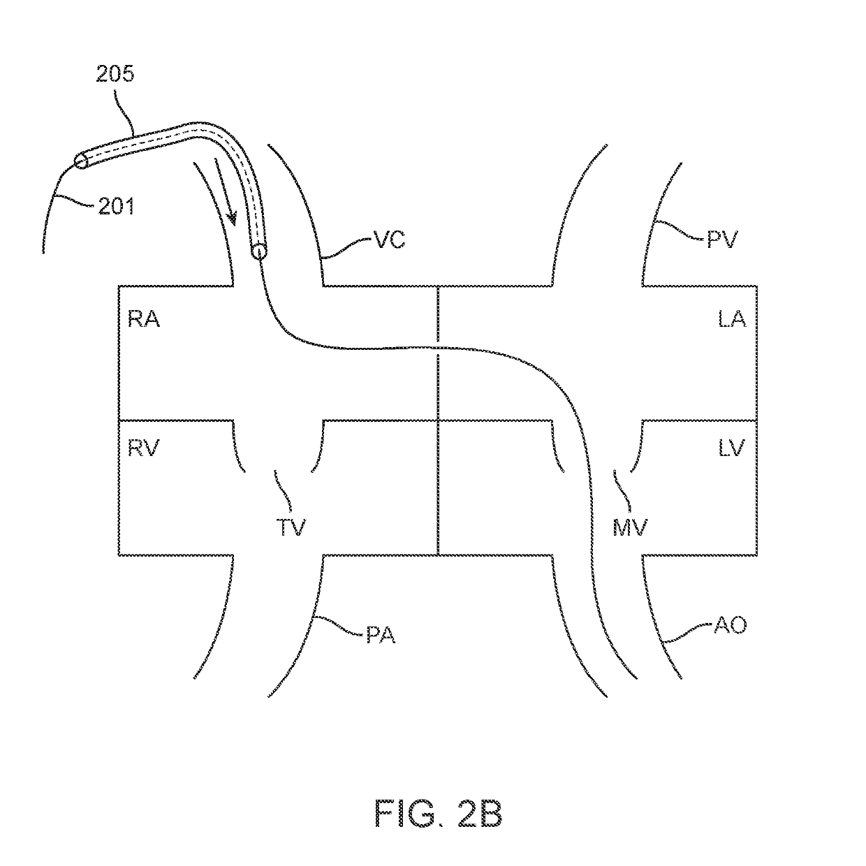 Antegrade hemodynamic support