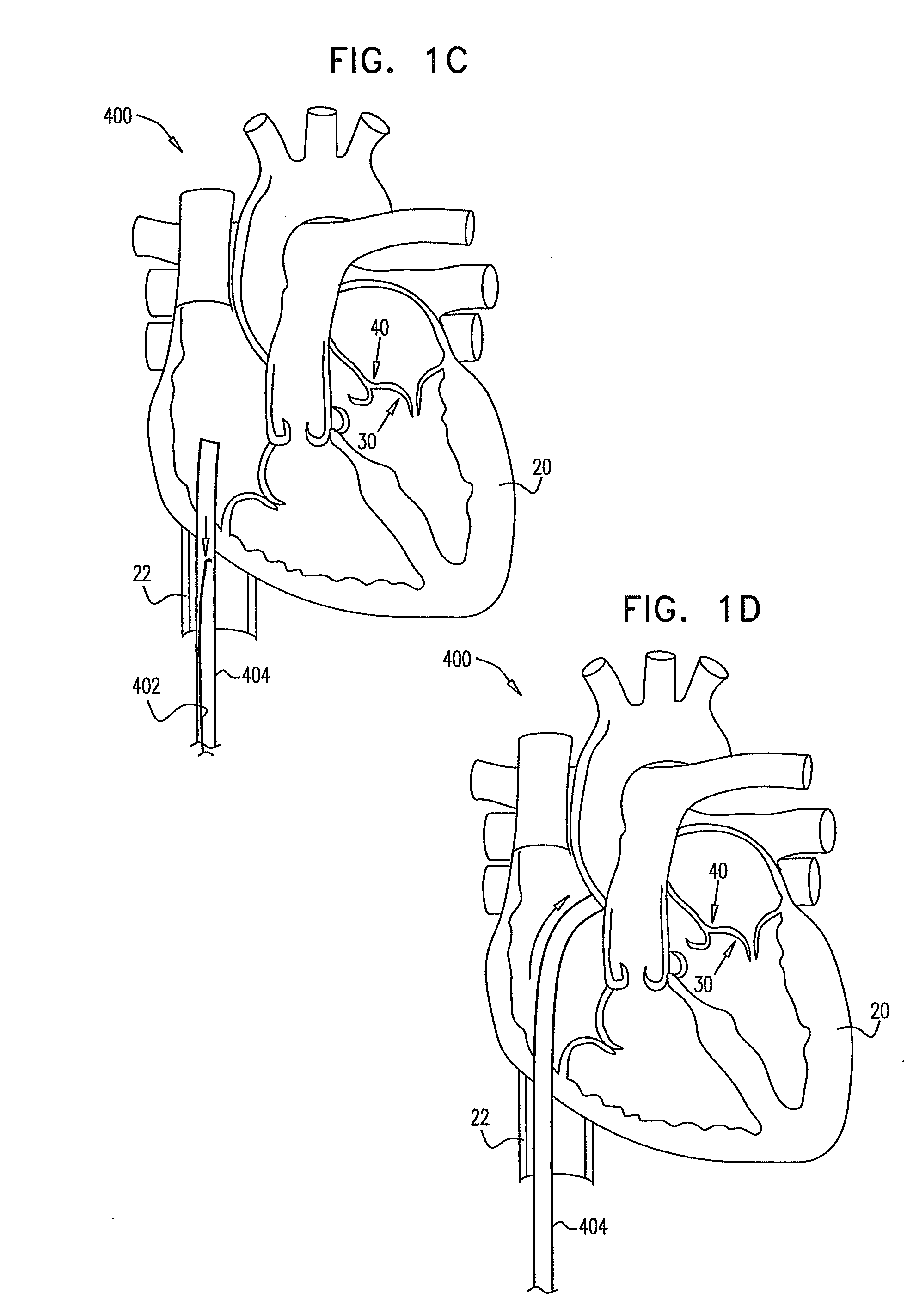 Segmented ring placement