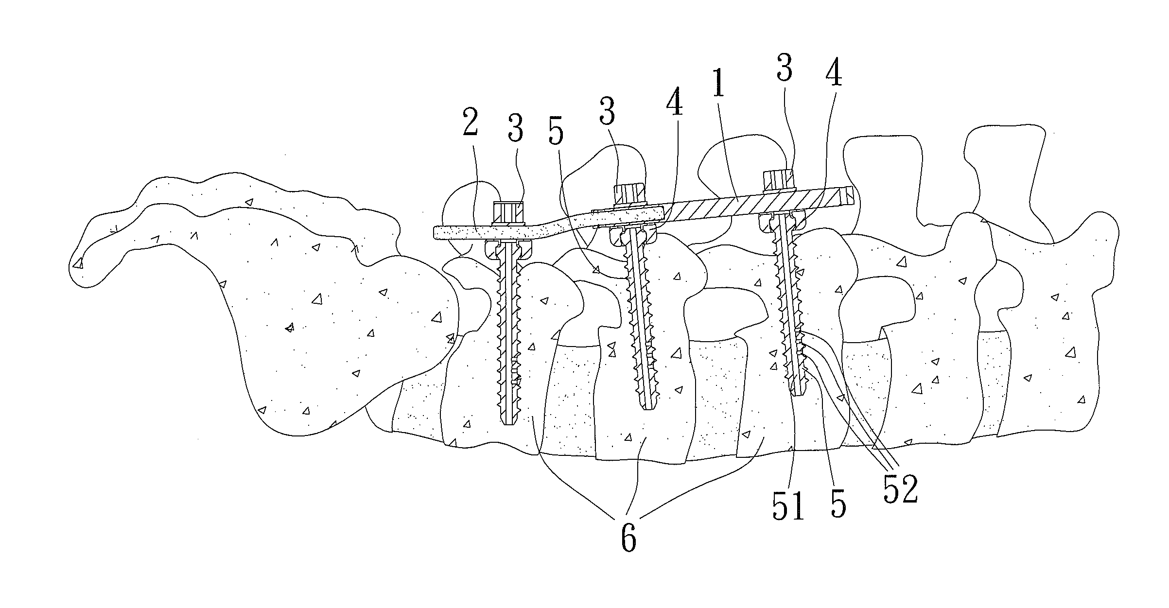 Fixing Structure of Bone Screws and a Connecting Rod for a Minimally Invasive Surgery