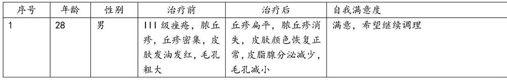 External compound formula for treating acne and preparation method of external compound formula