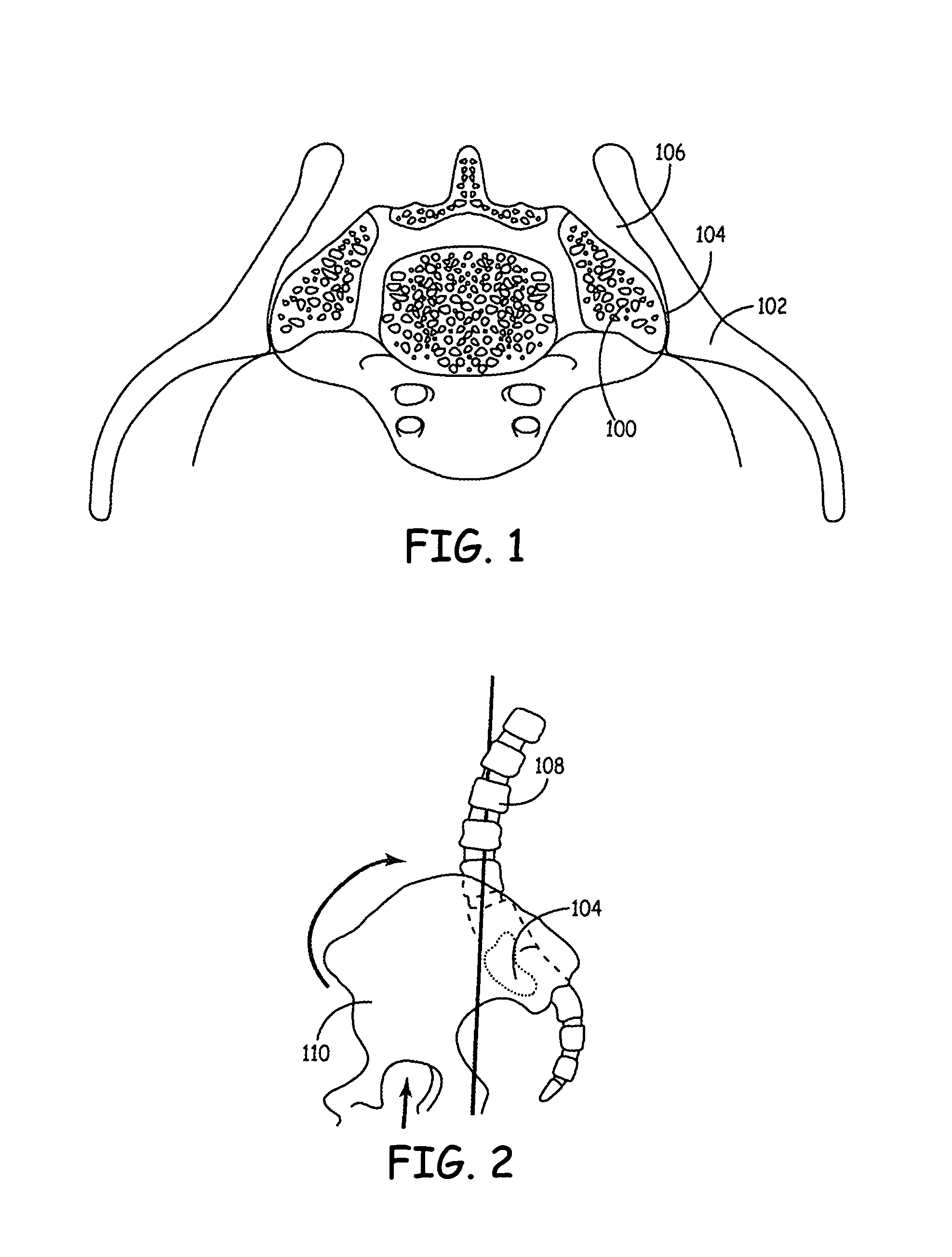 Tools for performing less invasive orthopedic joint procedures