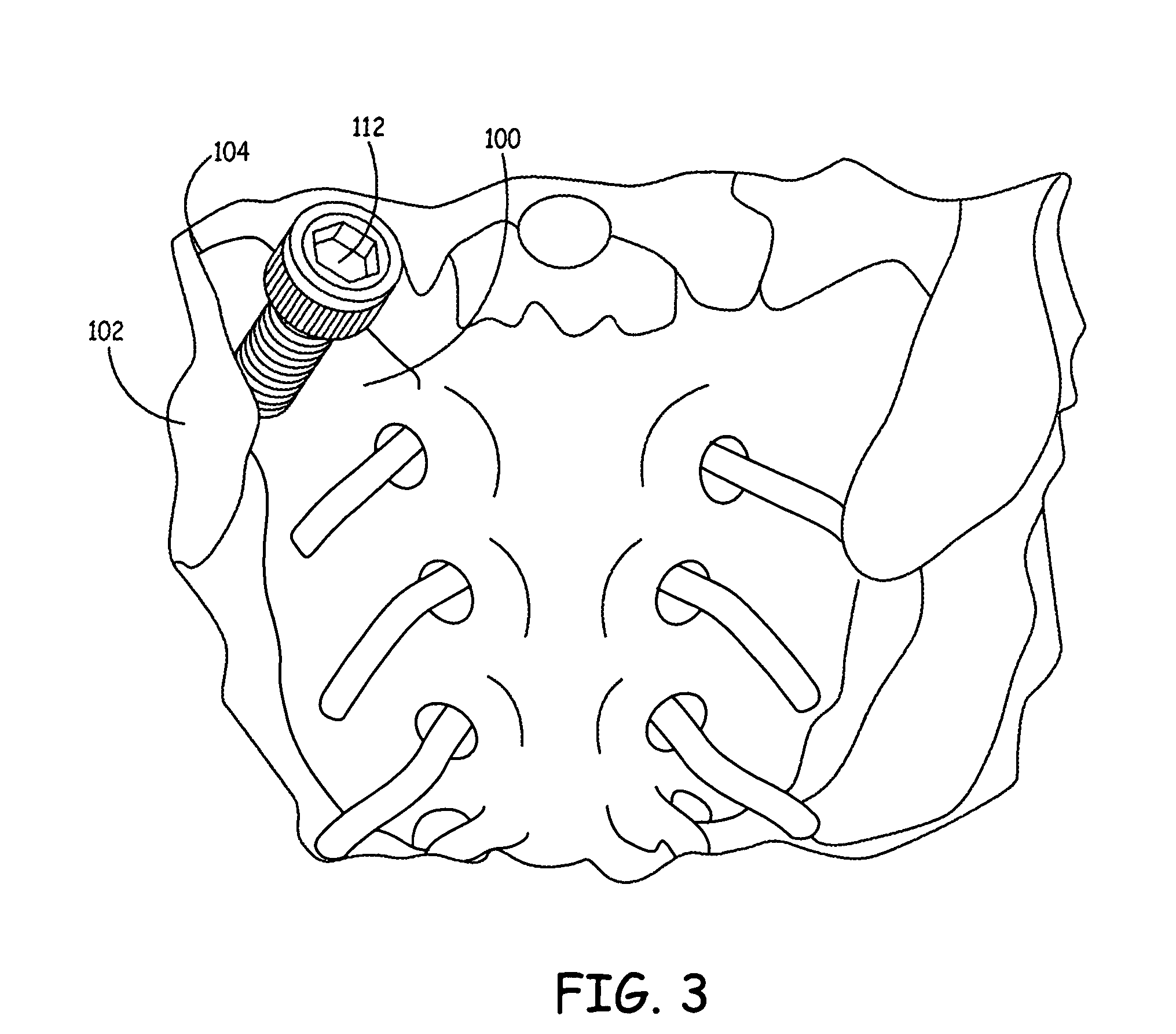 Tools for performing less invasive orthopedic joint procedures