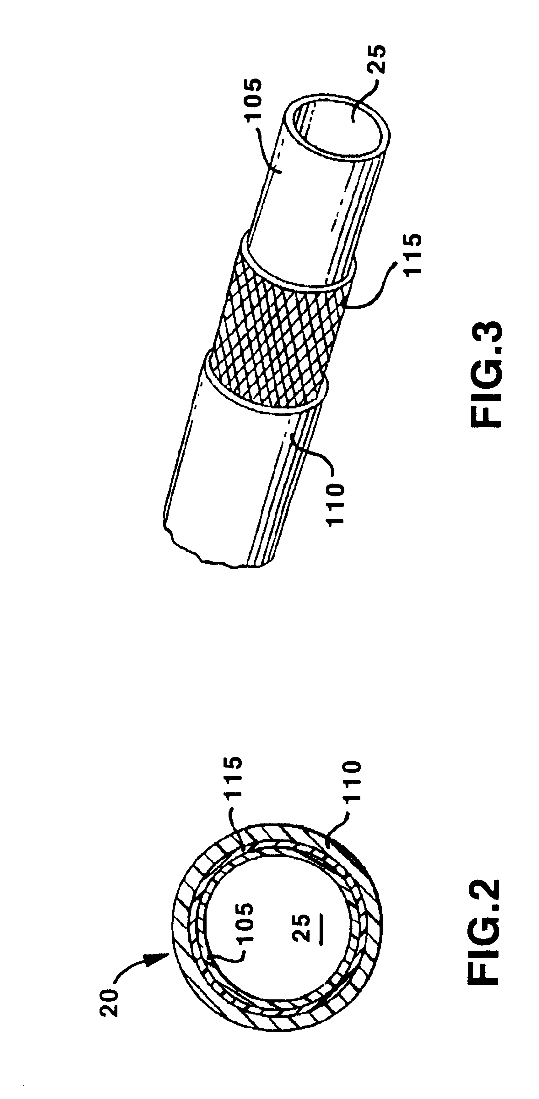 Guiding catheter with radiopaque band