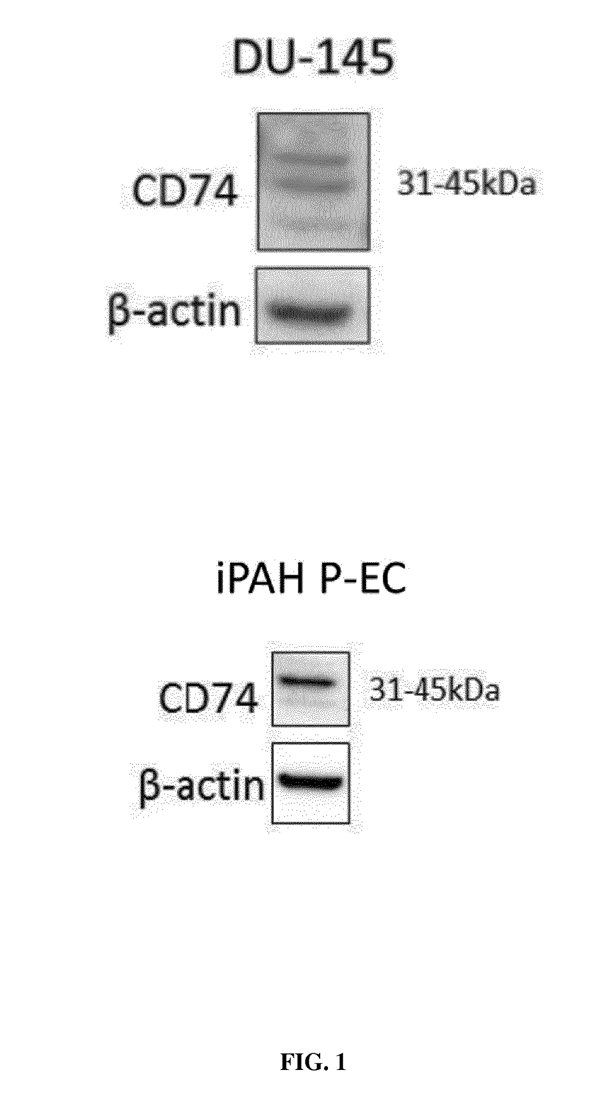 MIF inhibitors for the acute or chronic treatment of pulmonary hypertension