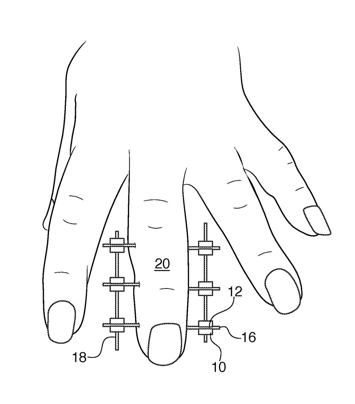 Bracket for external fixation of bones