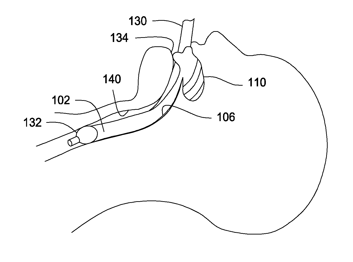 Devices and methods for prevention of ventilator associated pneumonia