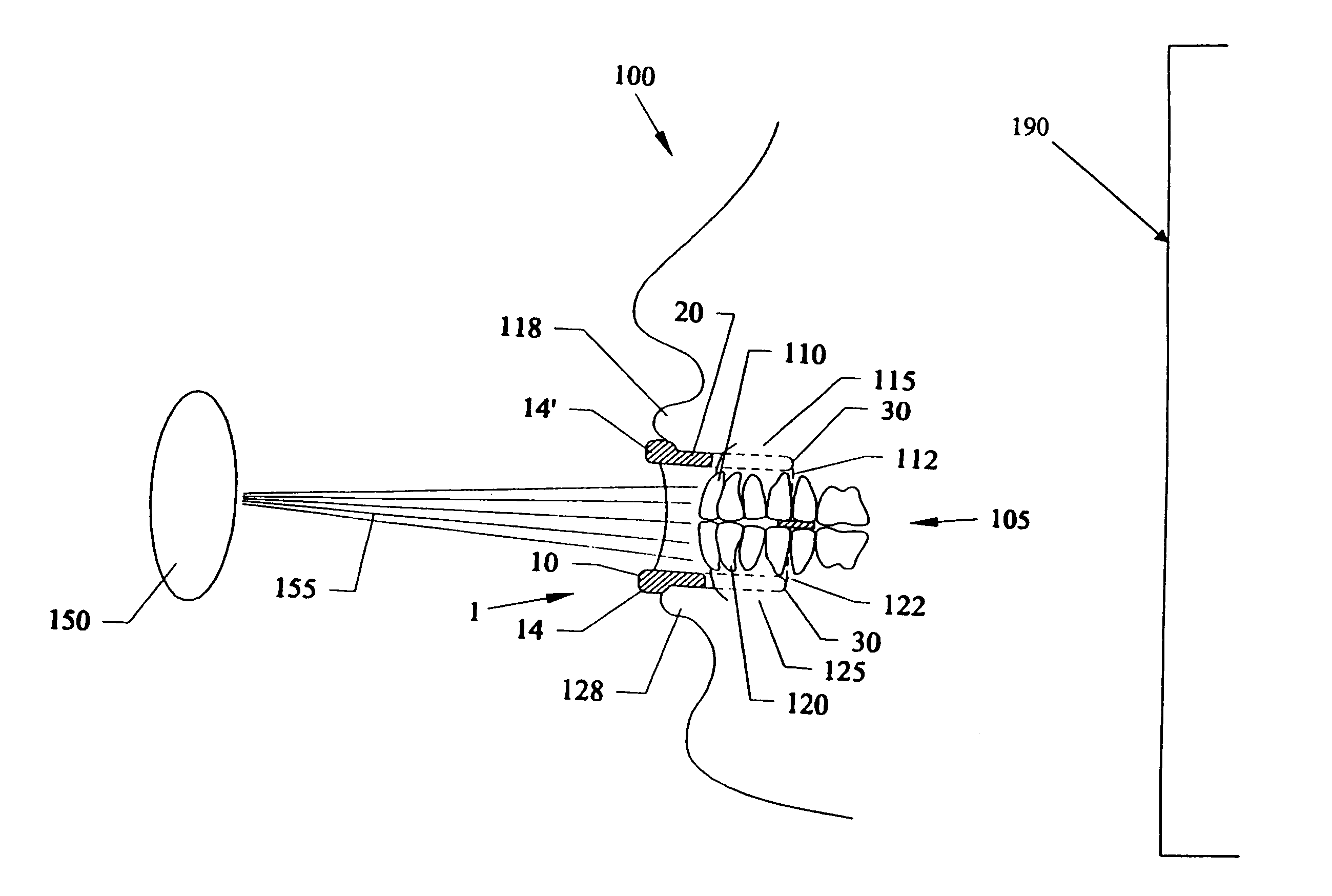 Mouthpiece devices and methods to allow UV whitening of teeth