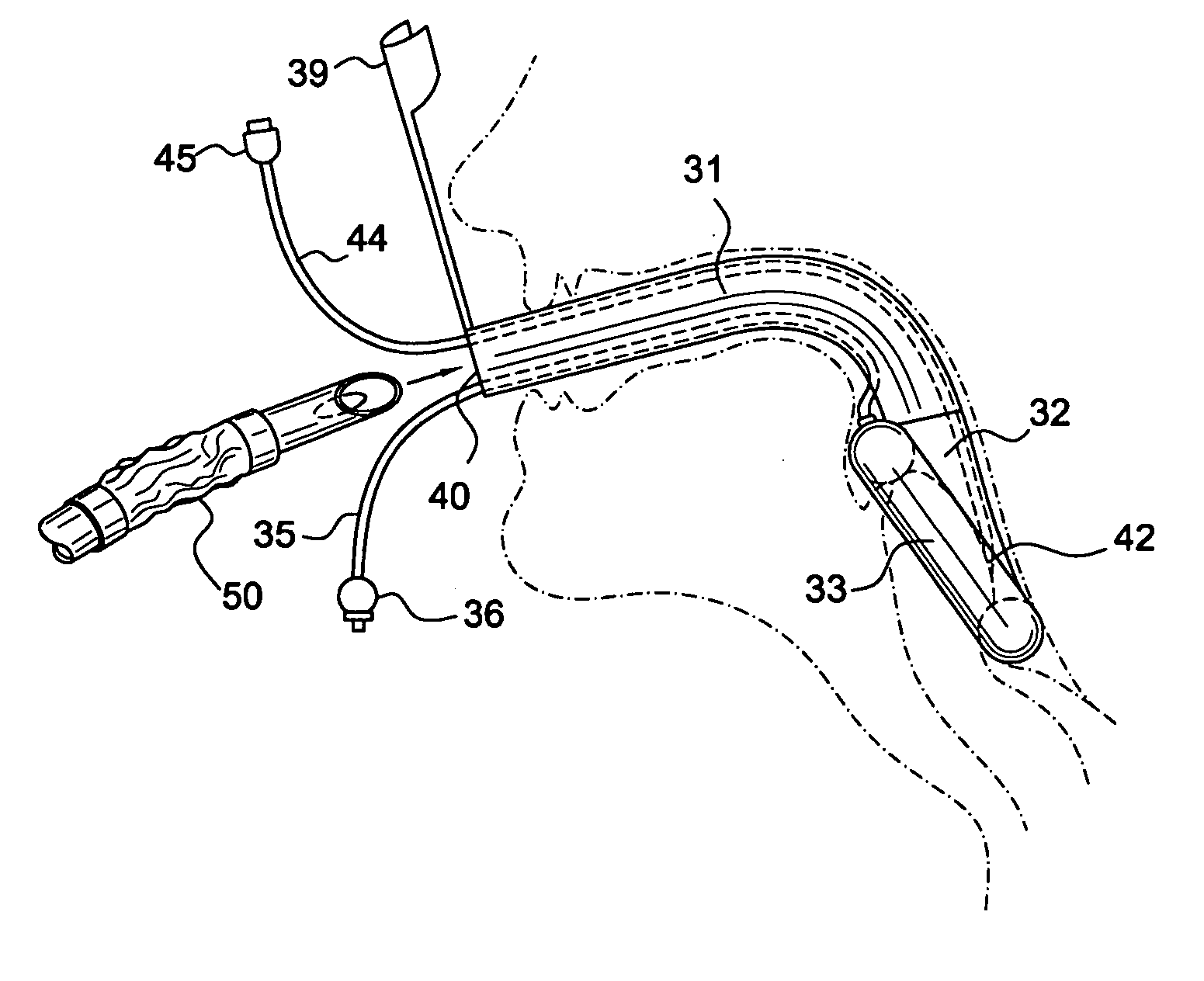 Video-assisted laryngeal mask airway devices