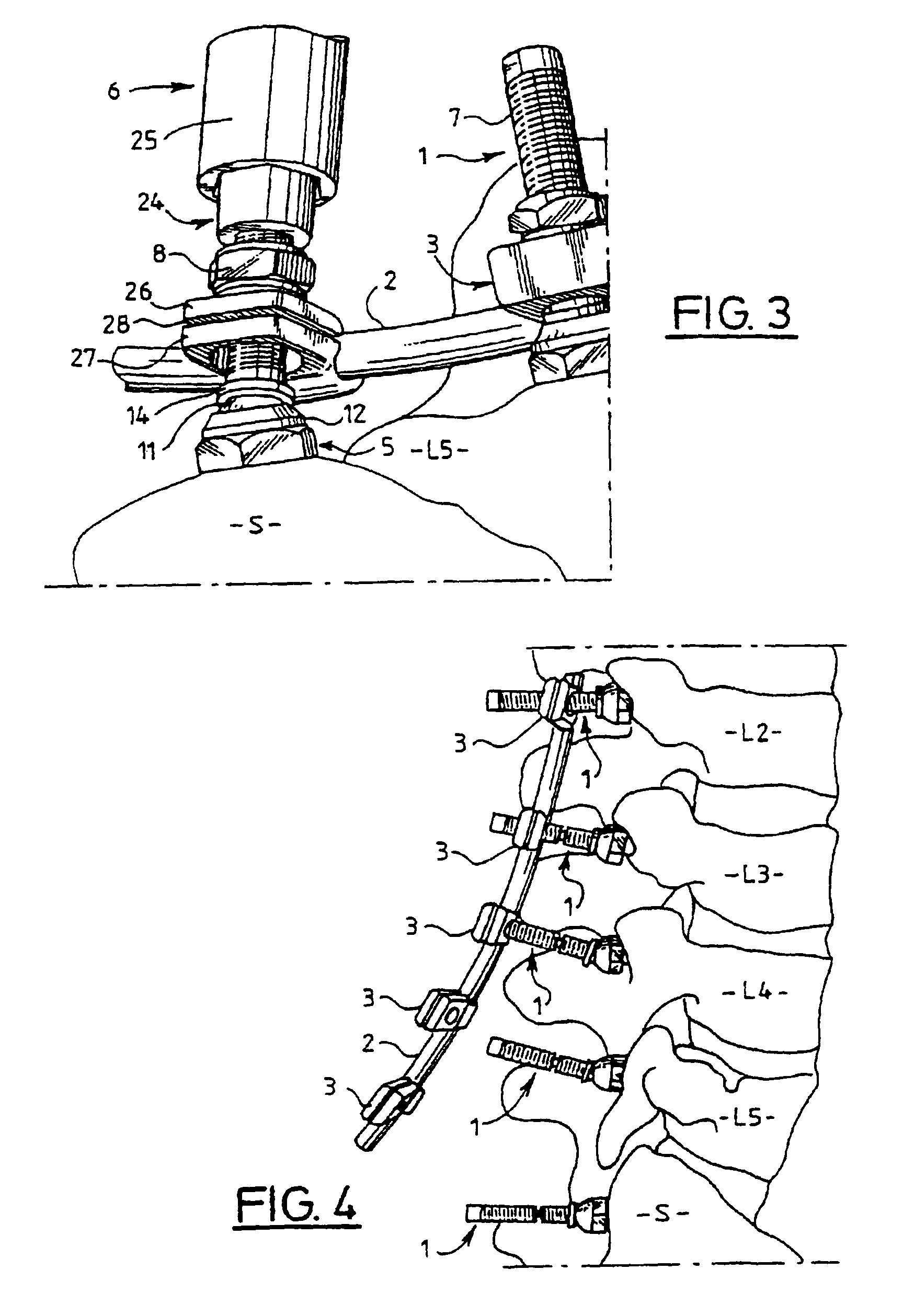 Multidirectional adaptable vertebral osteosyntsis device with reduced space requirement