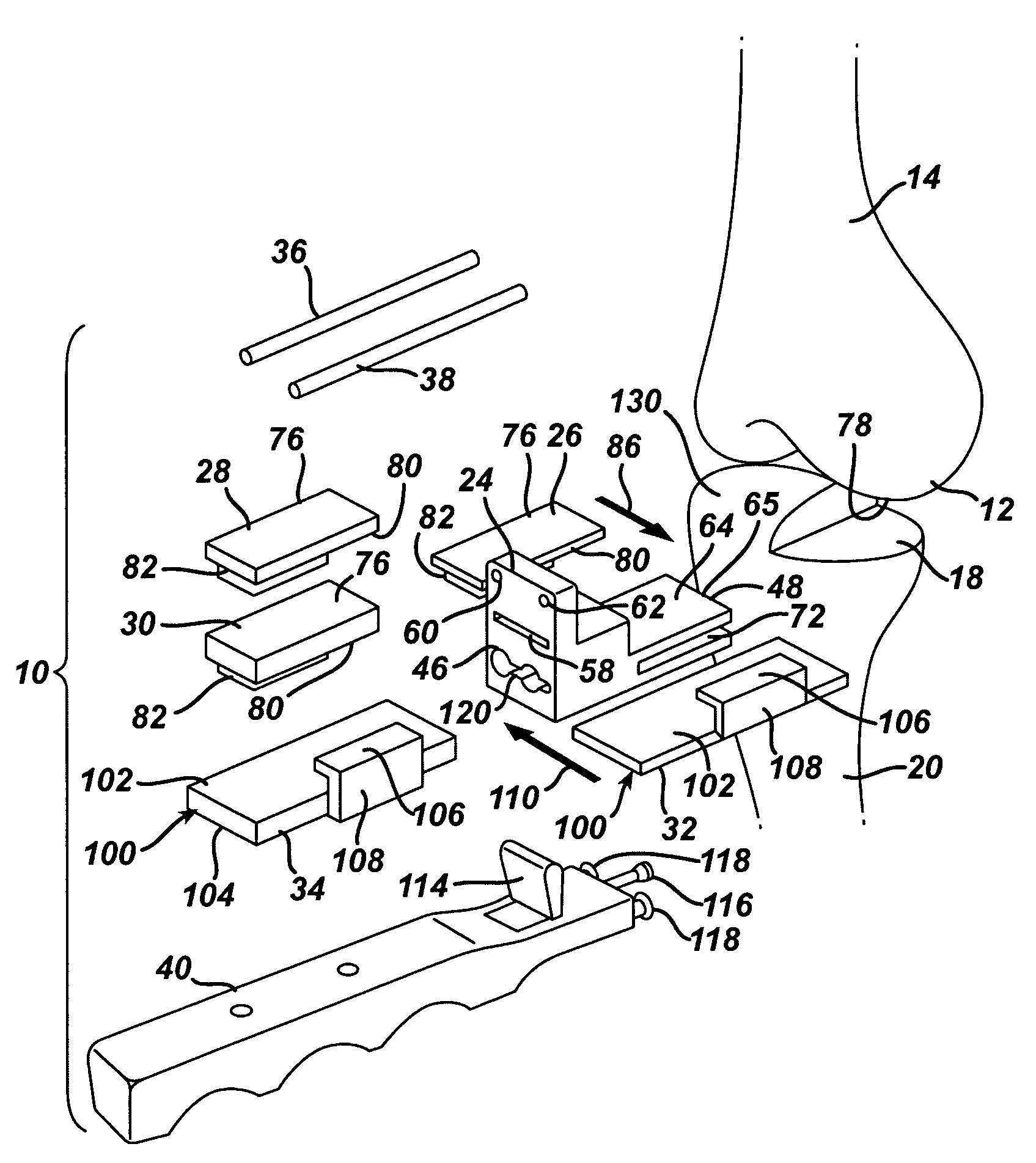 Kit, guide and method for locating distal femoral resection plane