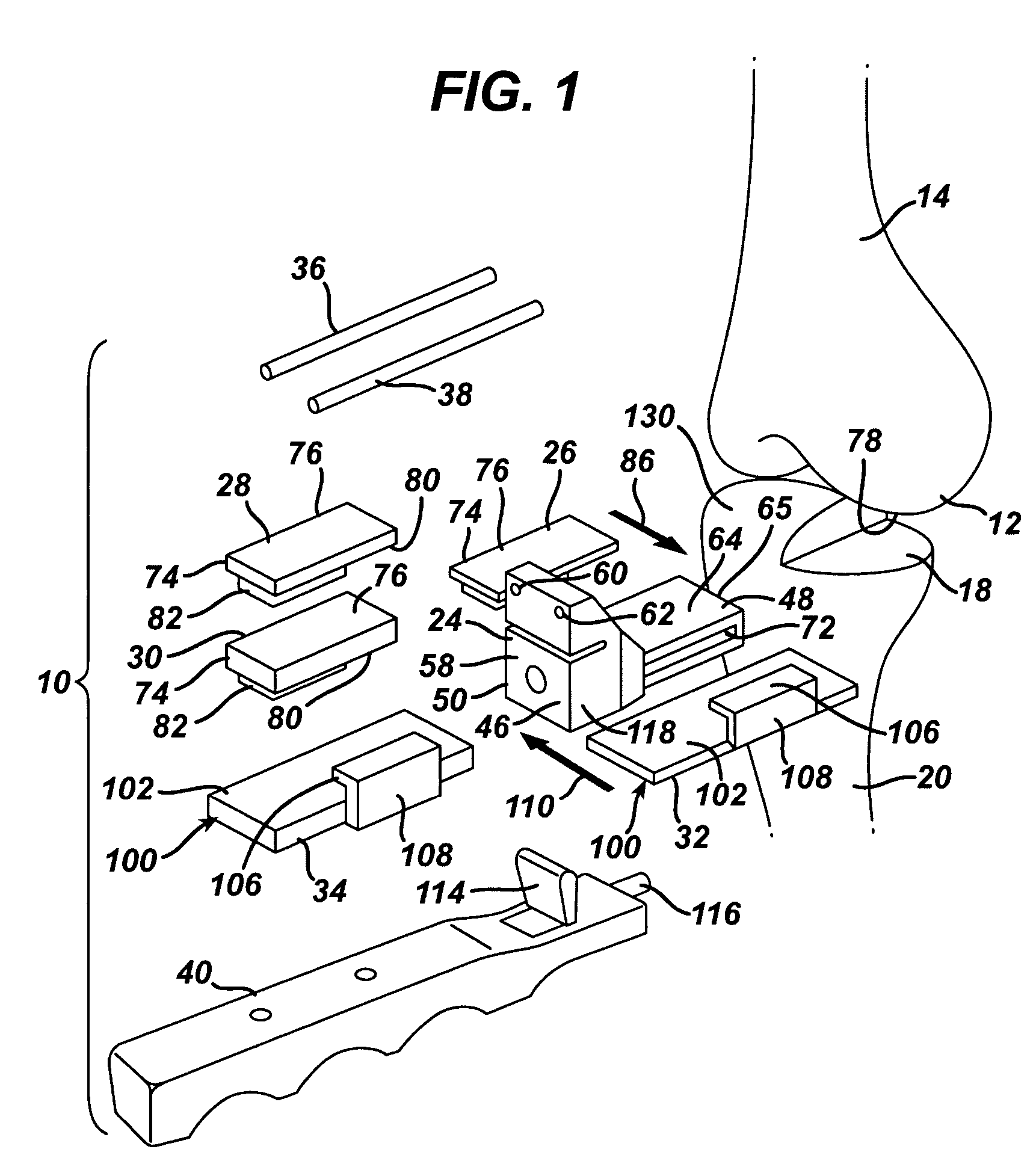 Kit, guide and method for locating distal femoral resection plane