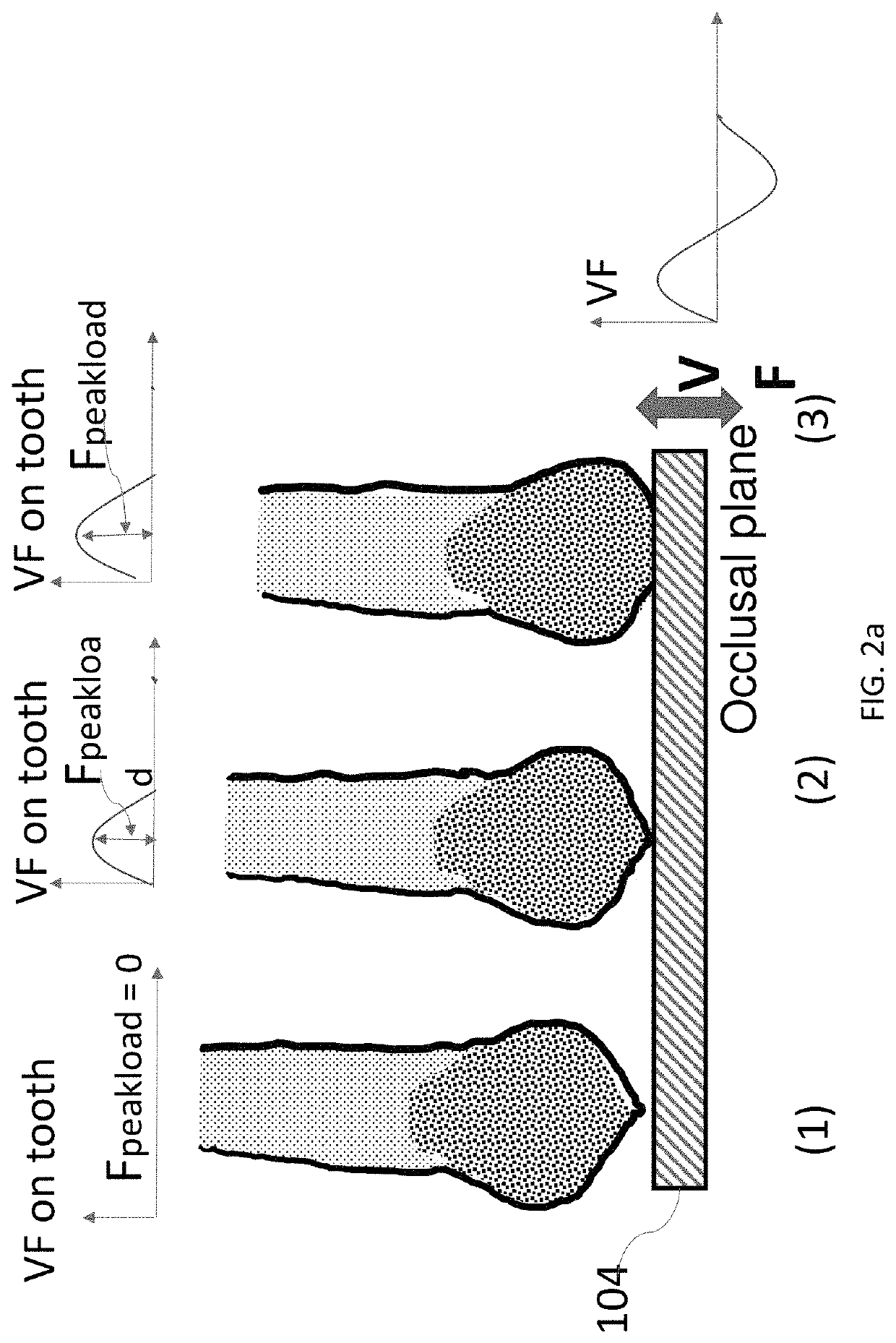 Patient-specific tray for orthodontic vibrational force management