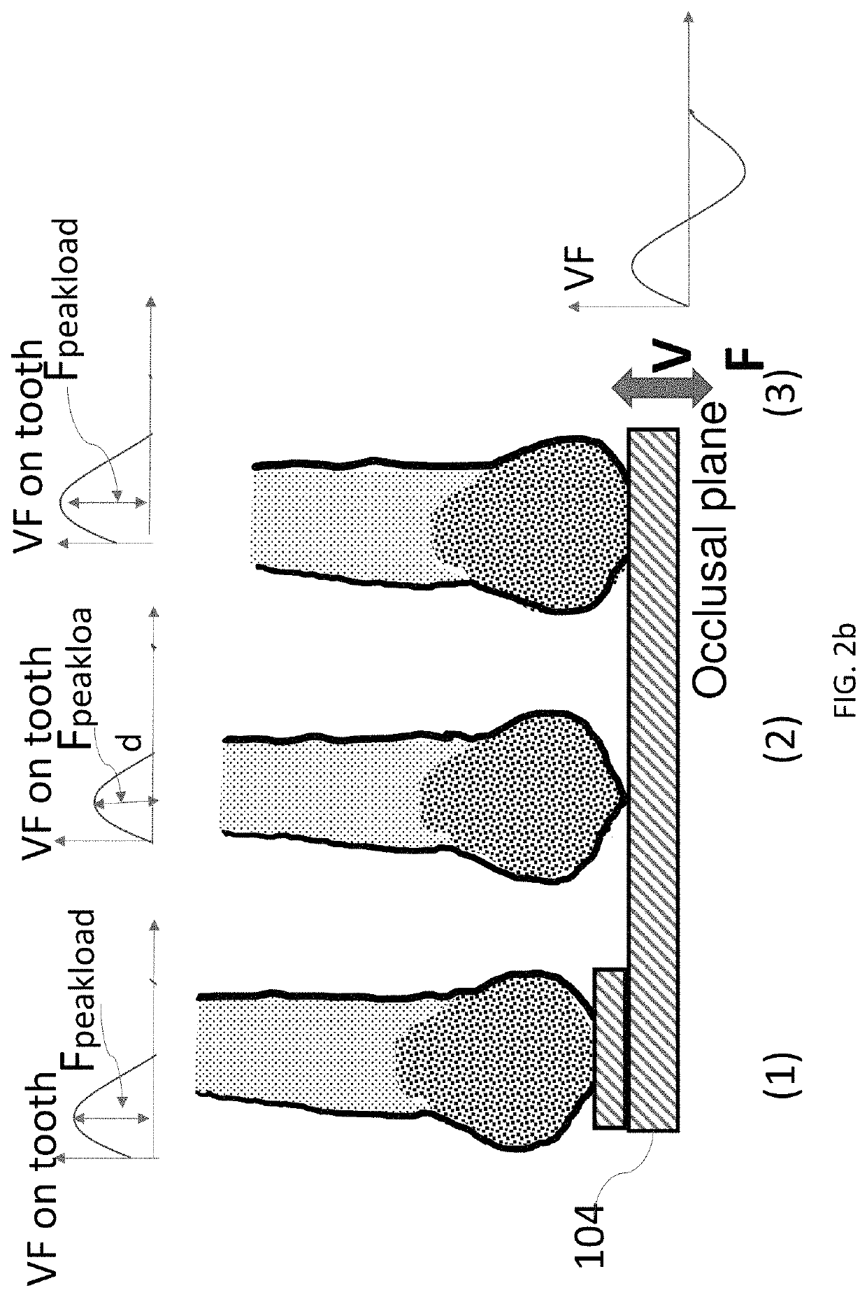 Patient-specific tray for orthodontic vibrational force management