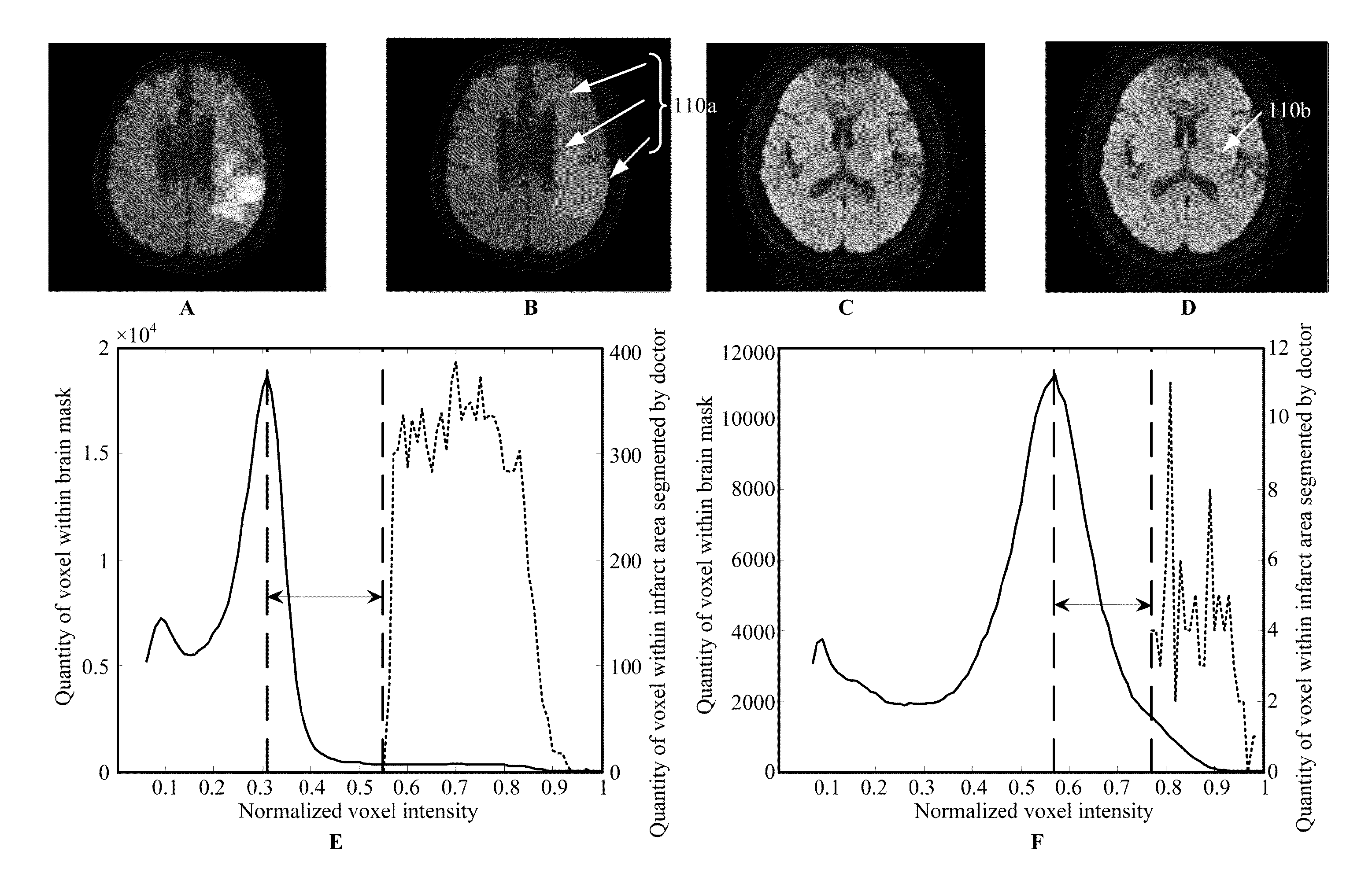 Method for detecting and quantifying cerebral infarct