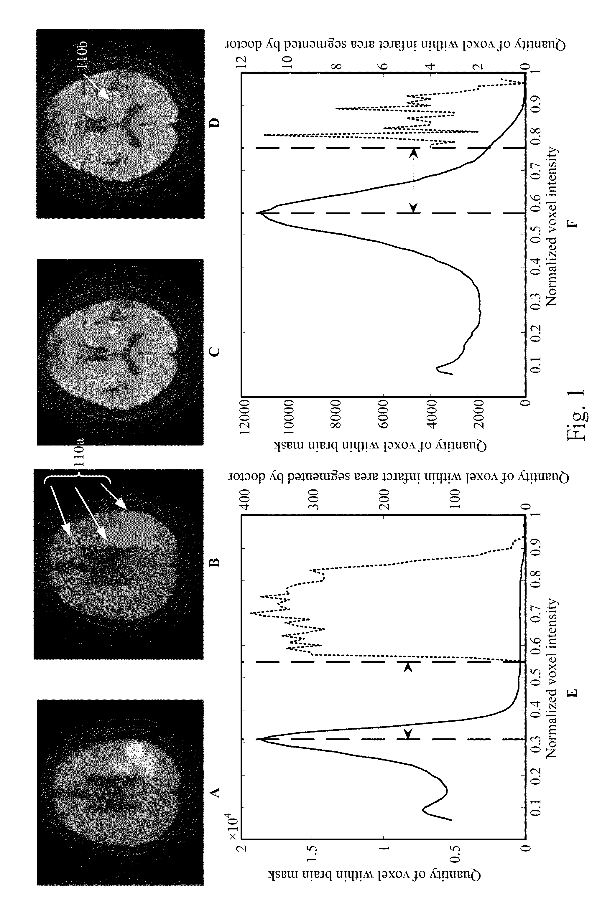 Method for detecting and quantifying cerebral infarct