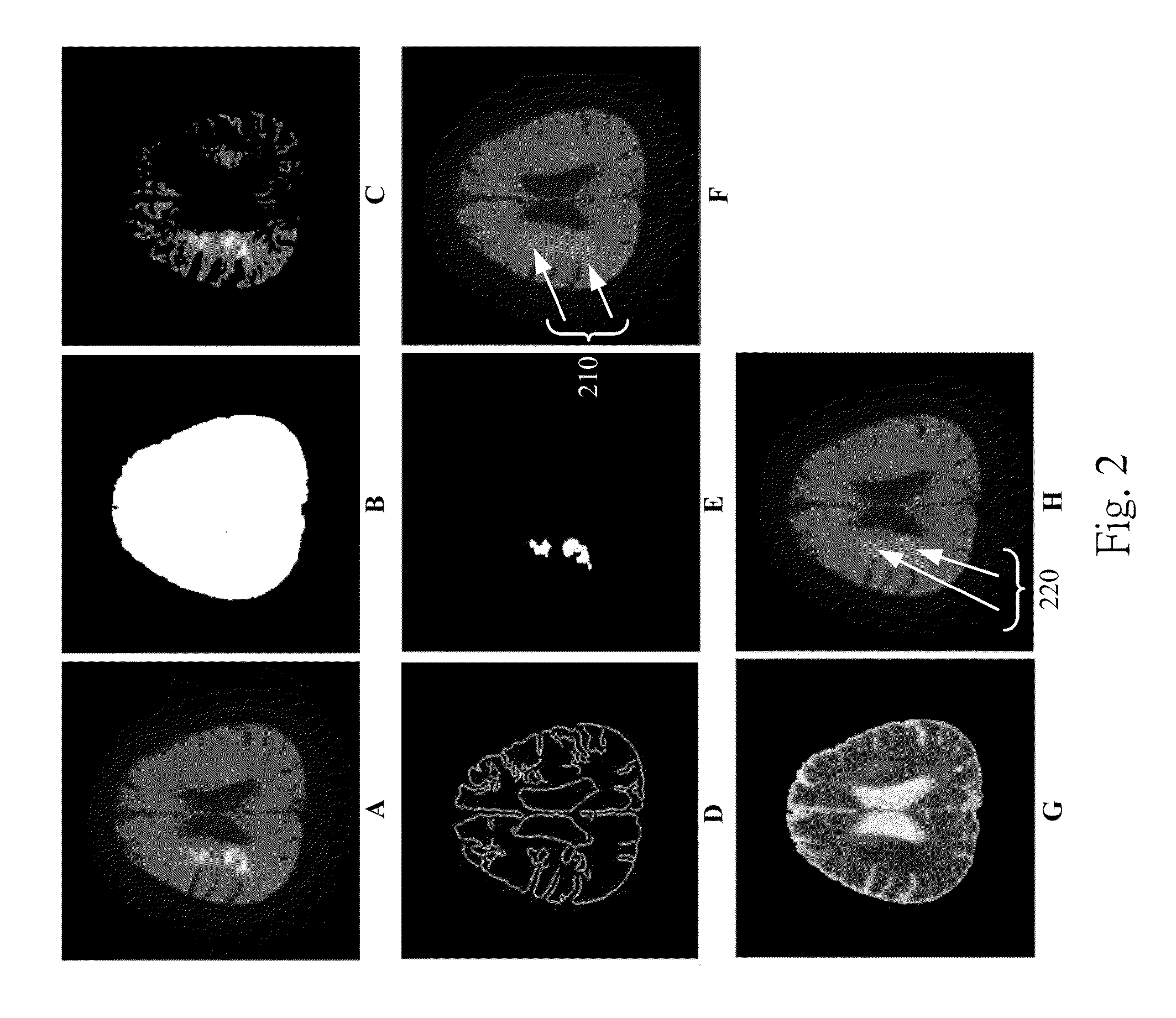 Method for detecting and quantifying cerebral infarct