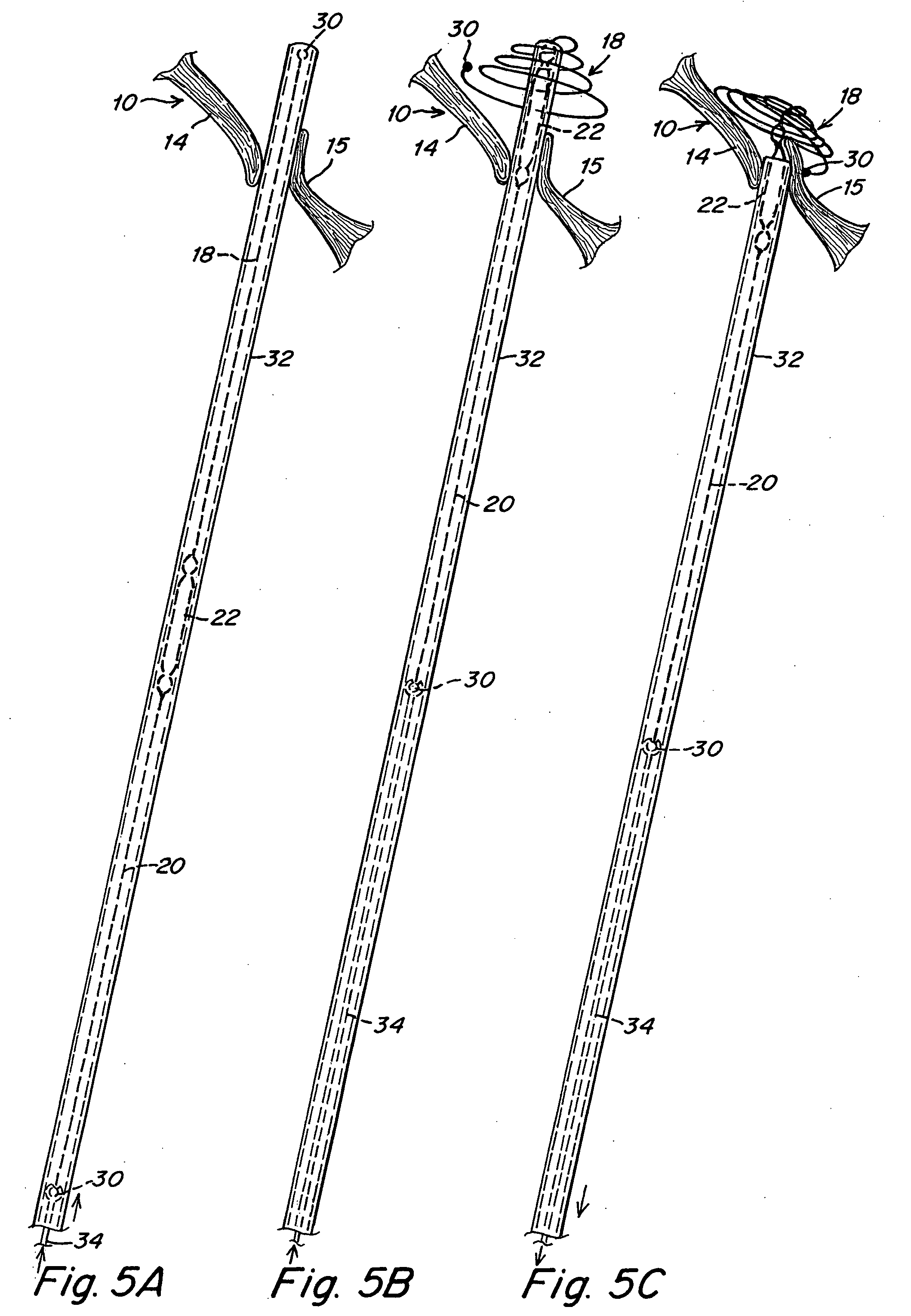 Double spiral patent foramen ovale closure clamp