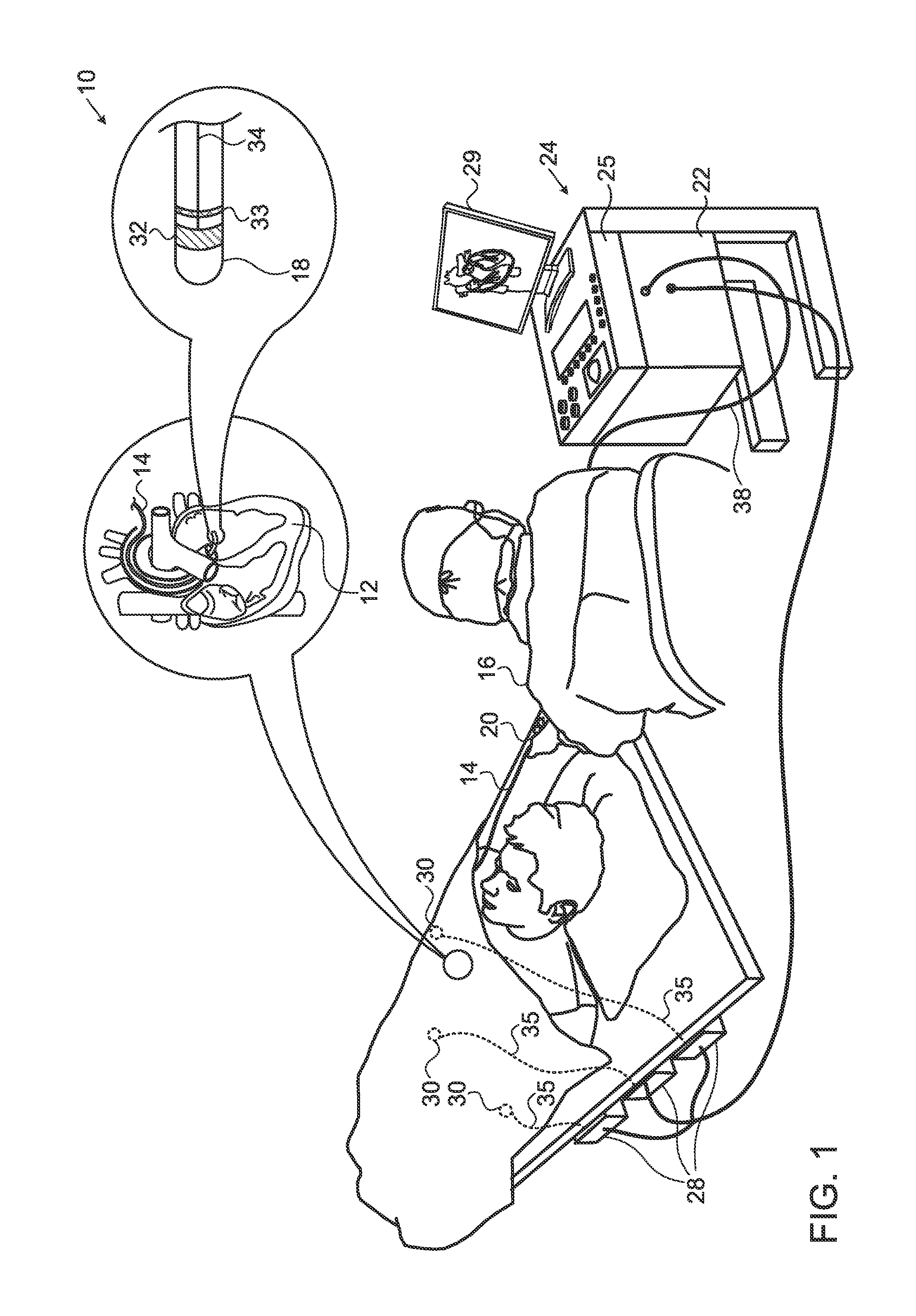 Method for mapping ventricular/atrial premature beats during sinus rhythm