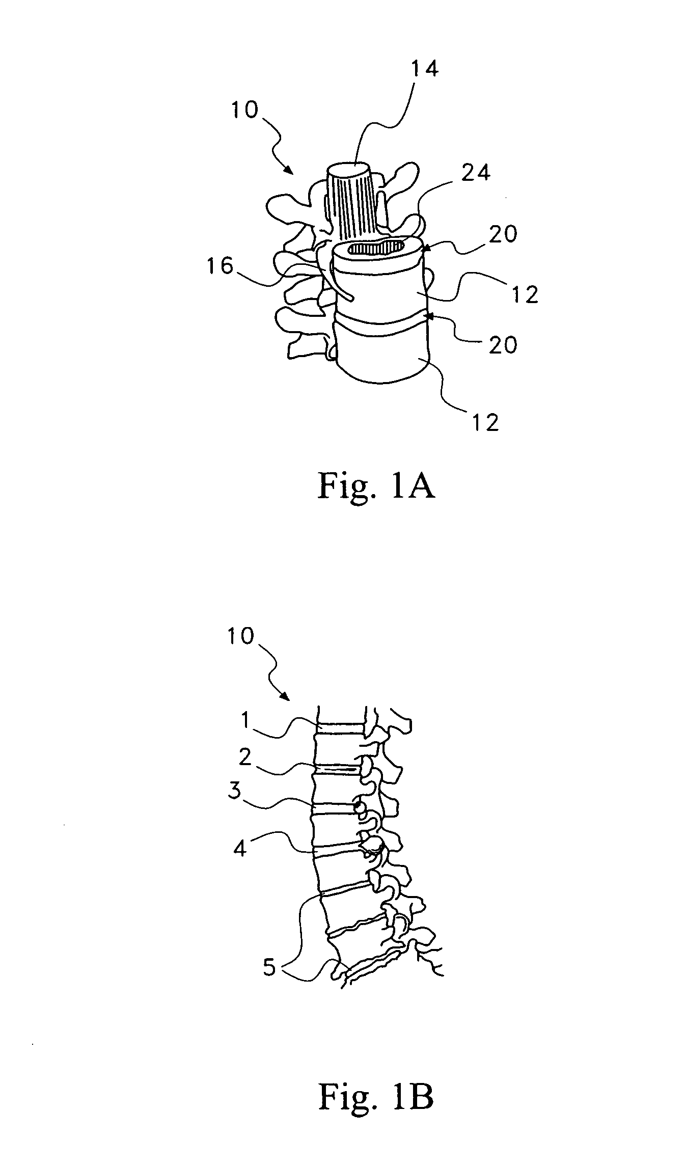 Pharmaceutical removal of neuronal extensions from a degenerating disc