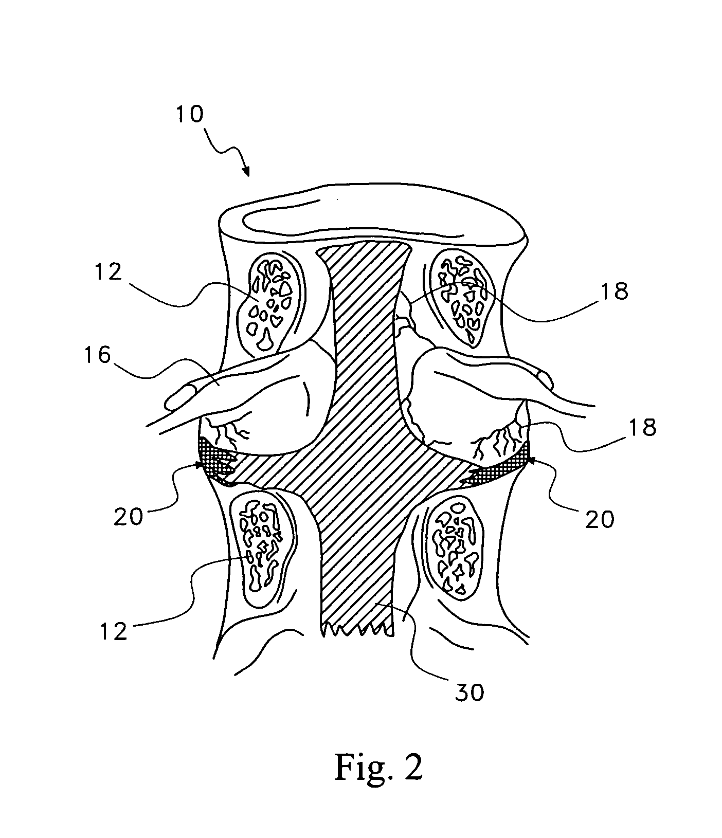 Pharmaceutical removal of neuronal extensions from a degenerating disc