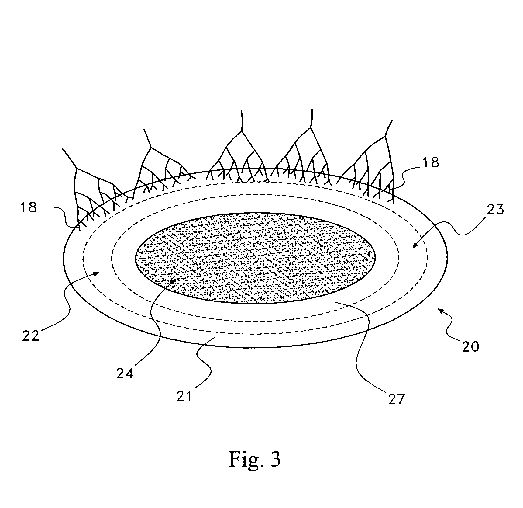 Pharmaceutical removal of neuronal extensions from a degenerating disc