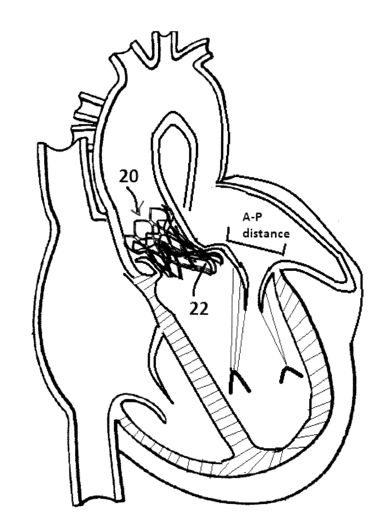 Method and design for a mitral regurgitation treatment device