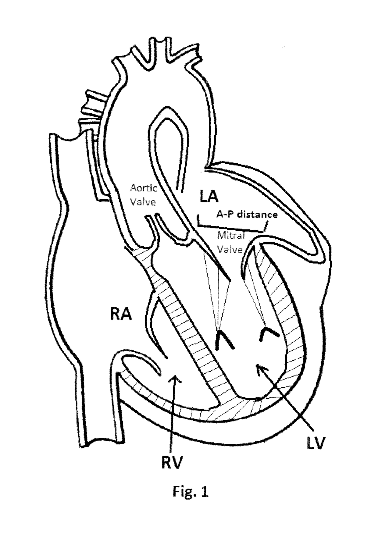 Method and design for a mitral regurgitation treatment device