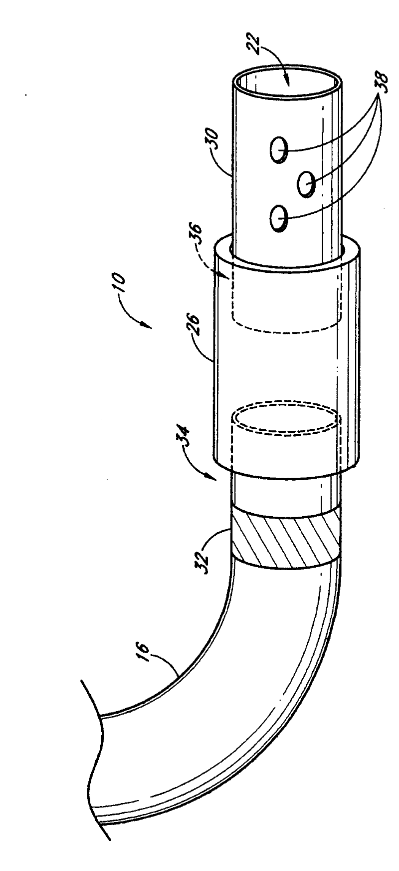 Detachable tip microcatheter