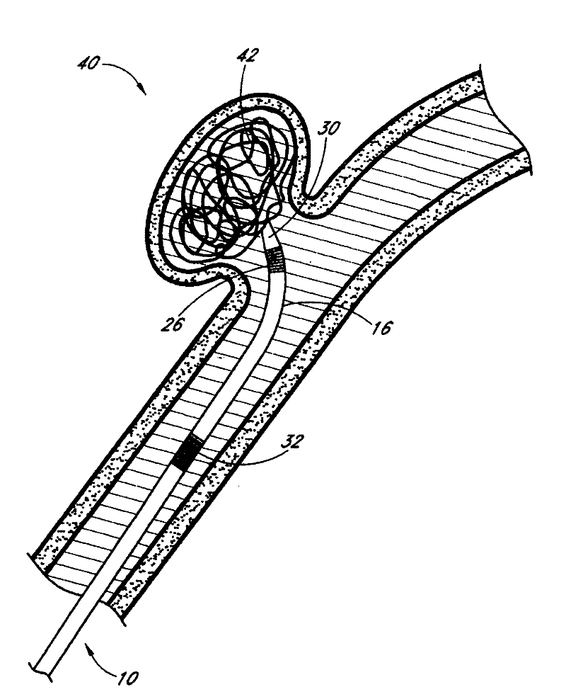 Detachable tip microcatheter