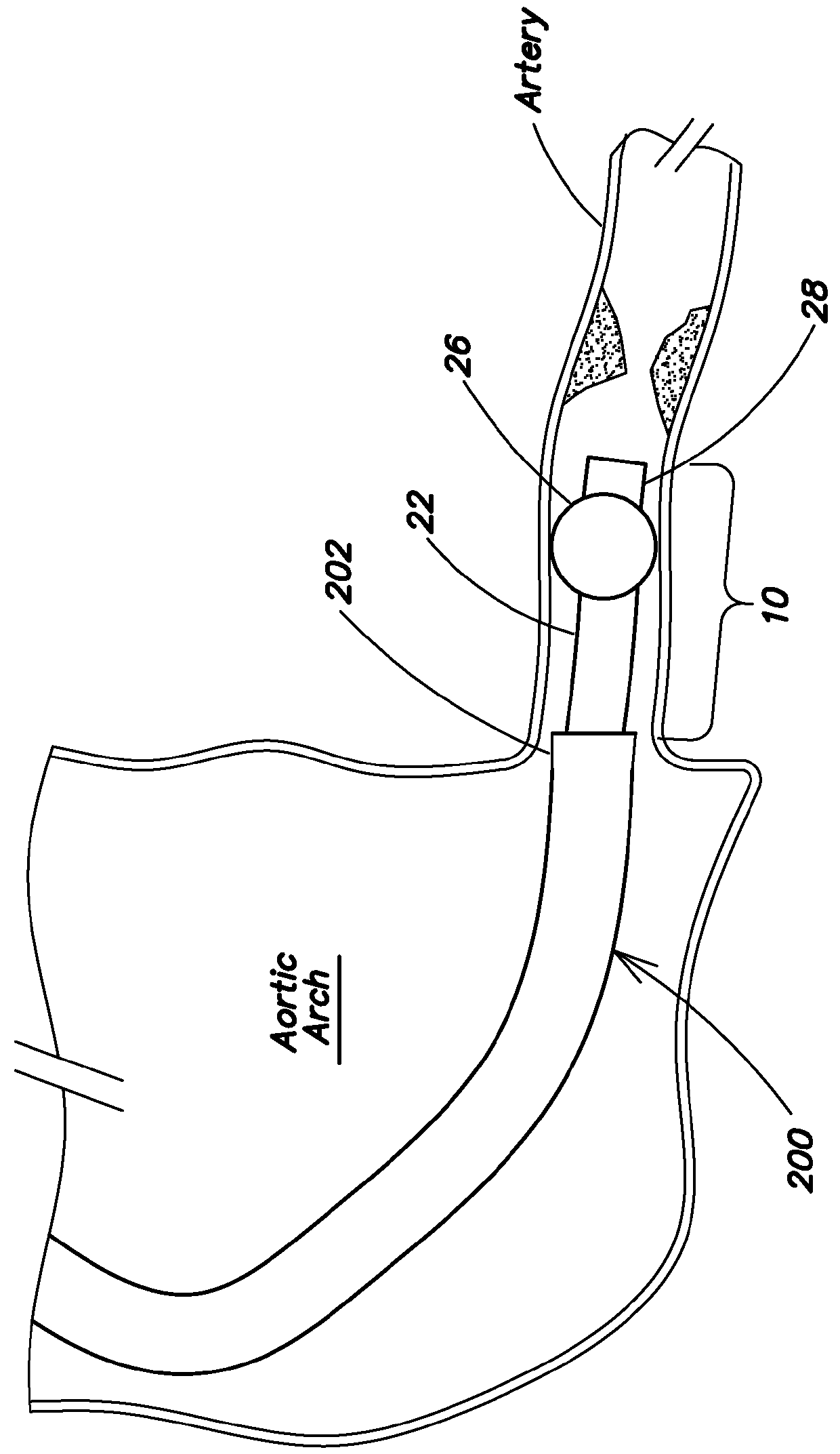 Stabilizing and sealing catheter for use with a guiding catheter