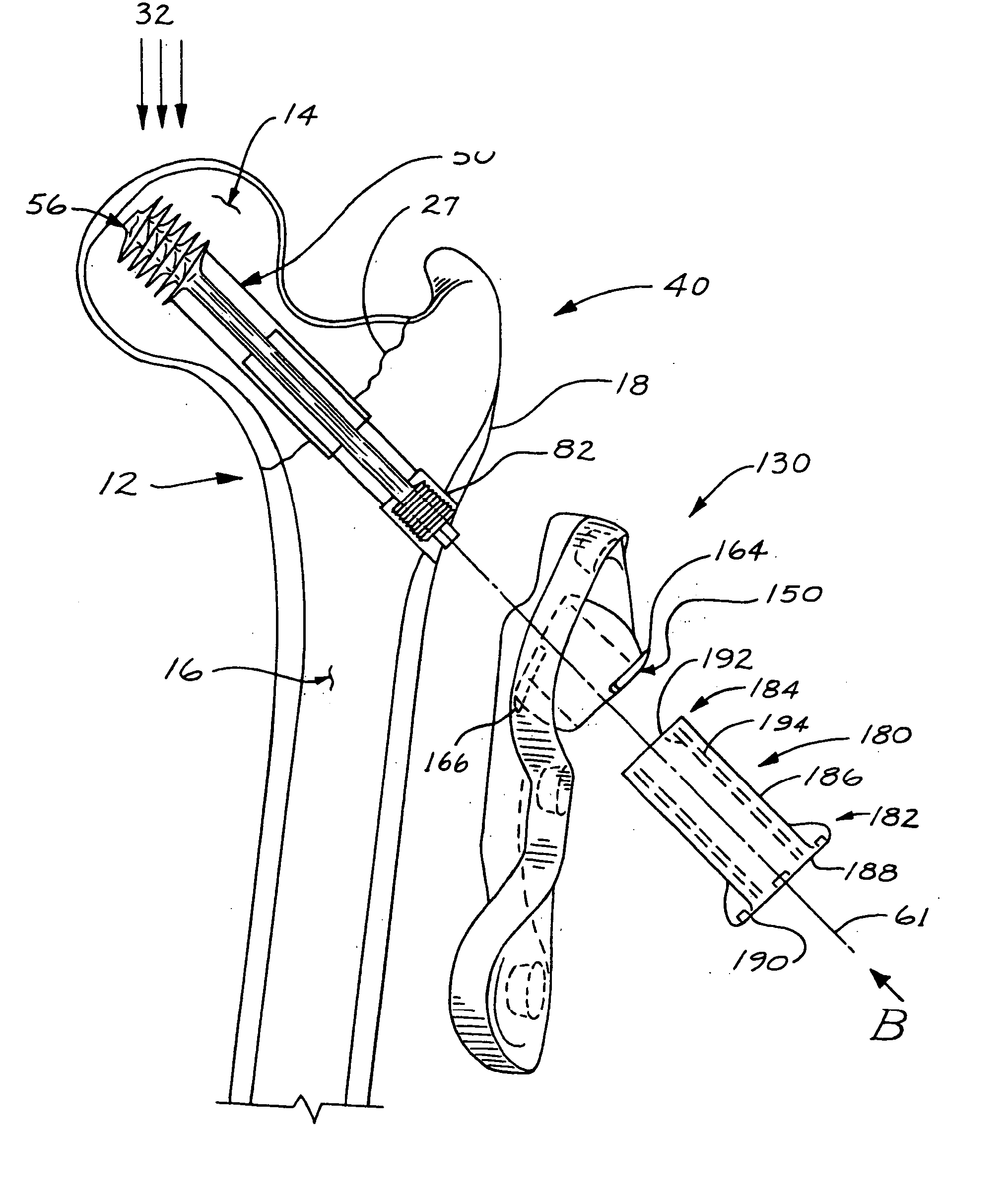 Compression bone screw device