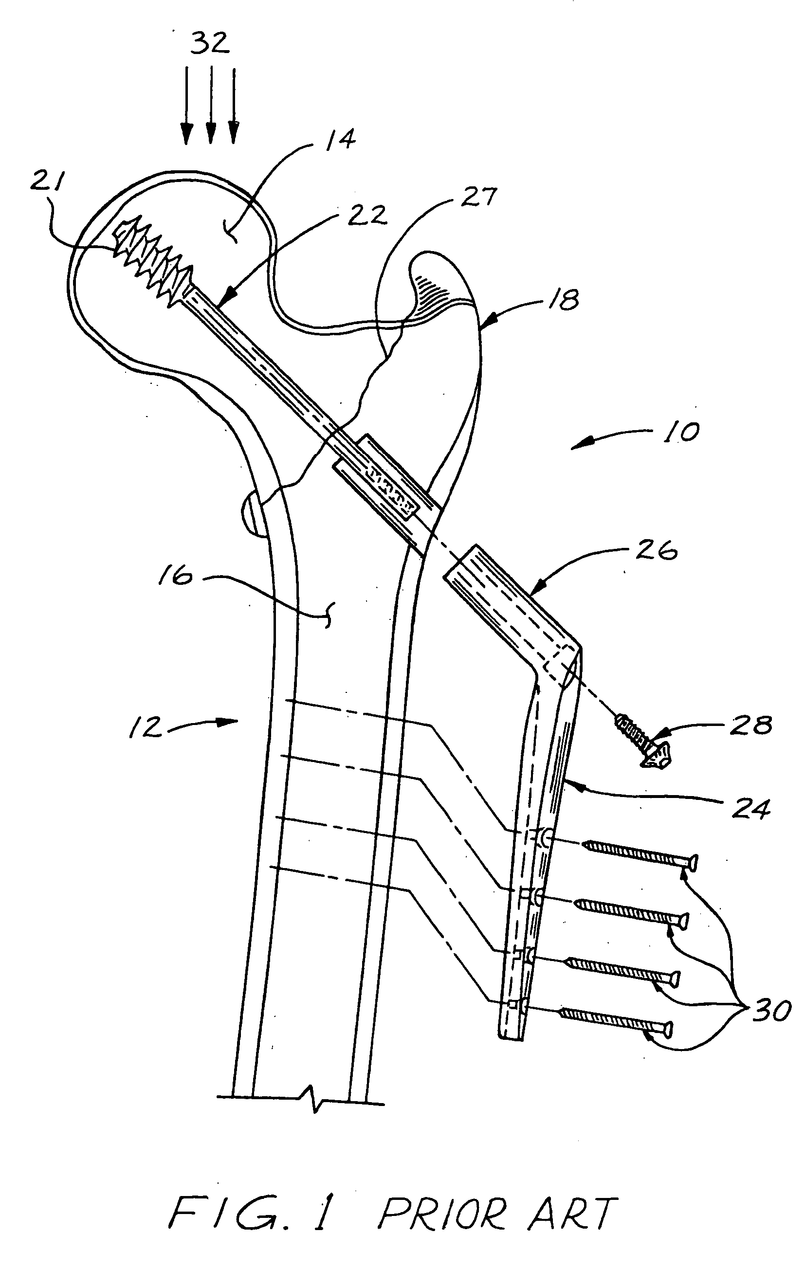 Compression bone screw device