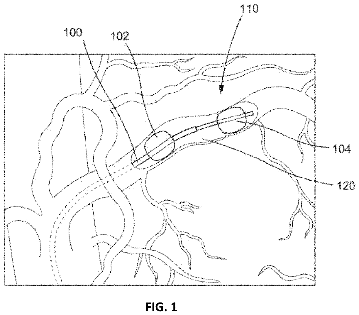 Methods and apparatuses for treating tumors