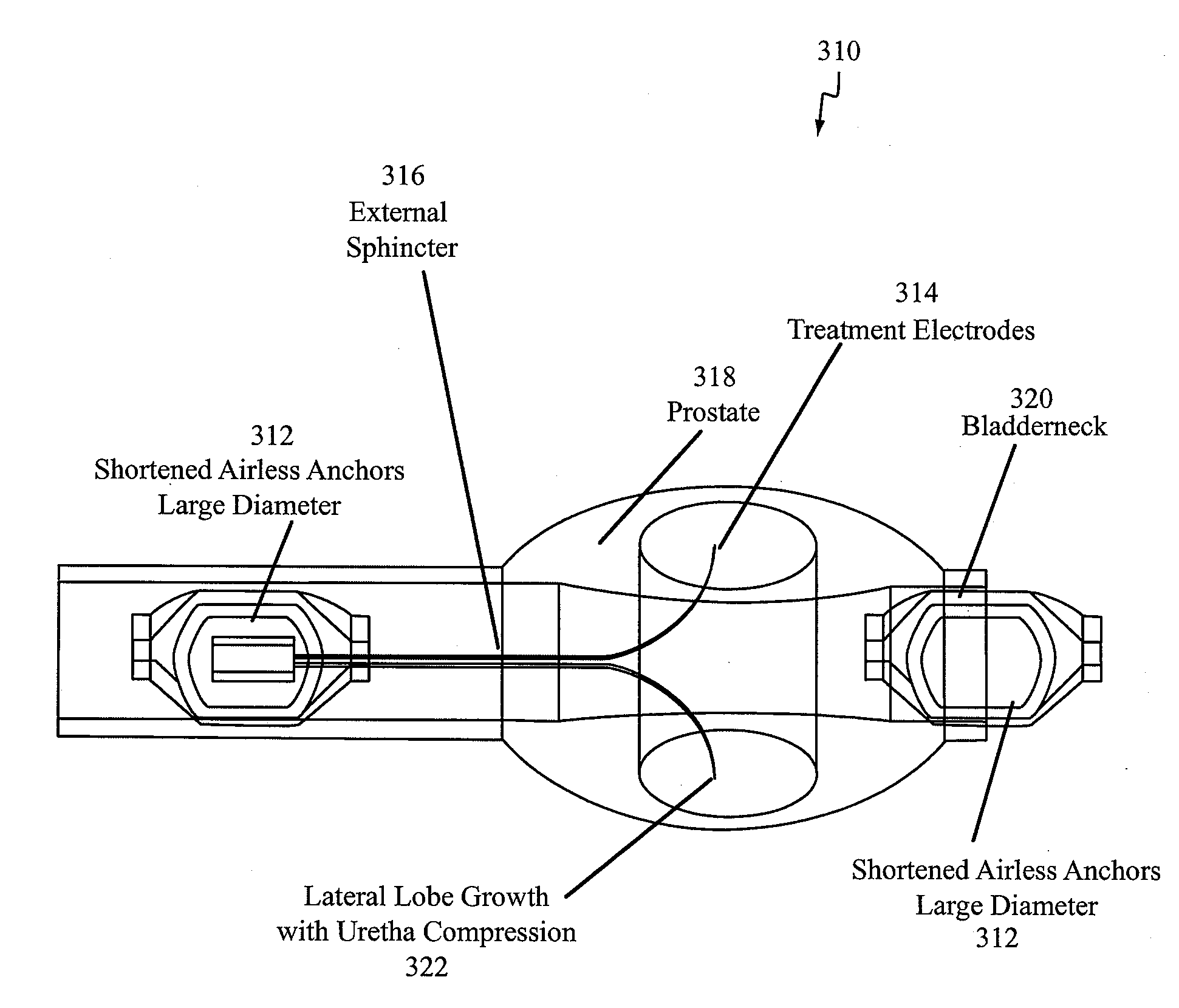 Non-Thermal Ablation System for Treating BPH and Other Growths